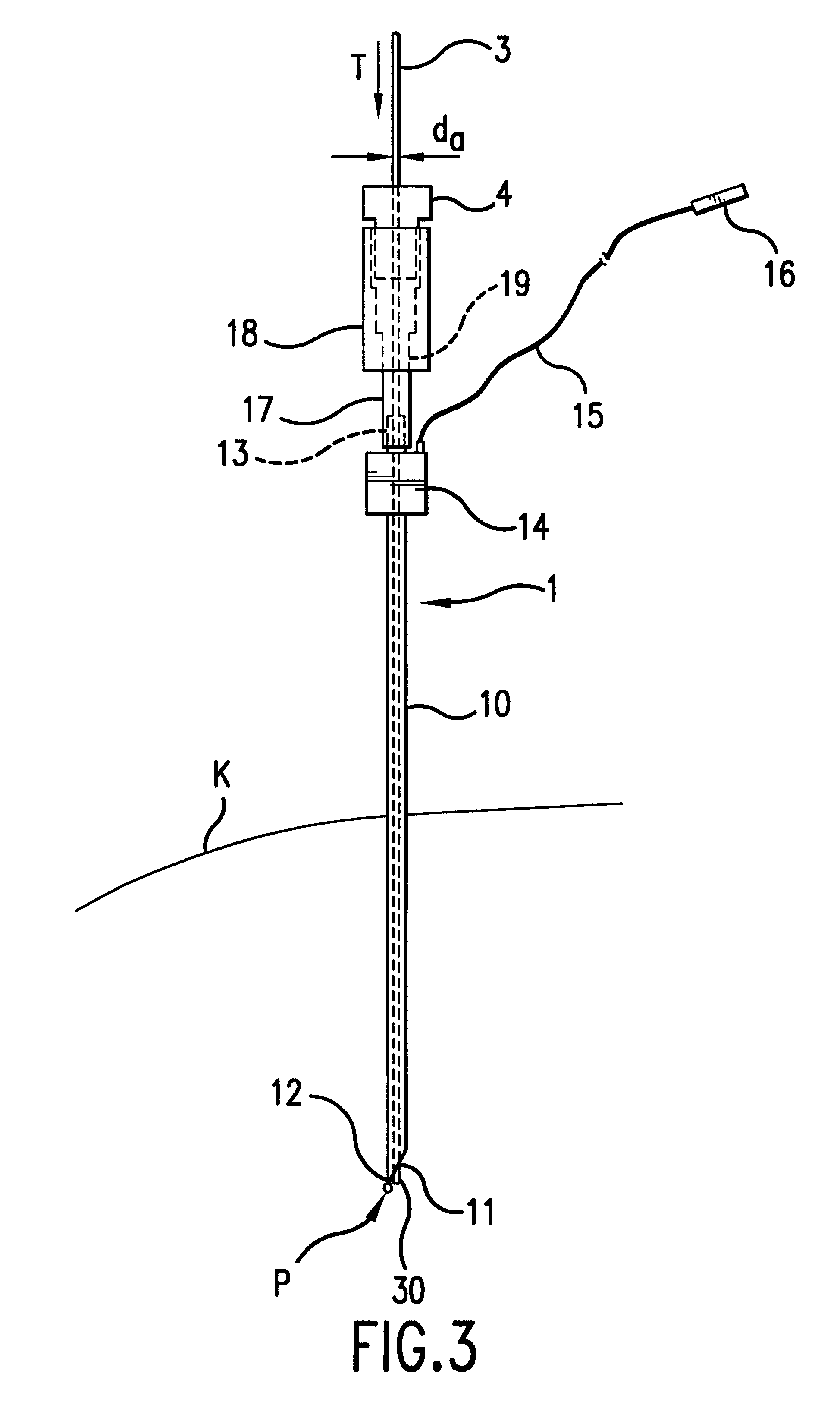 Device and method for the location and catheterization of the surroundings of a nerve
