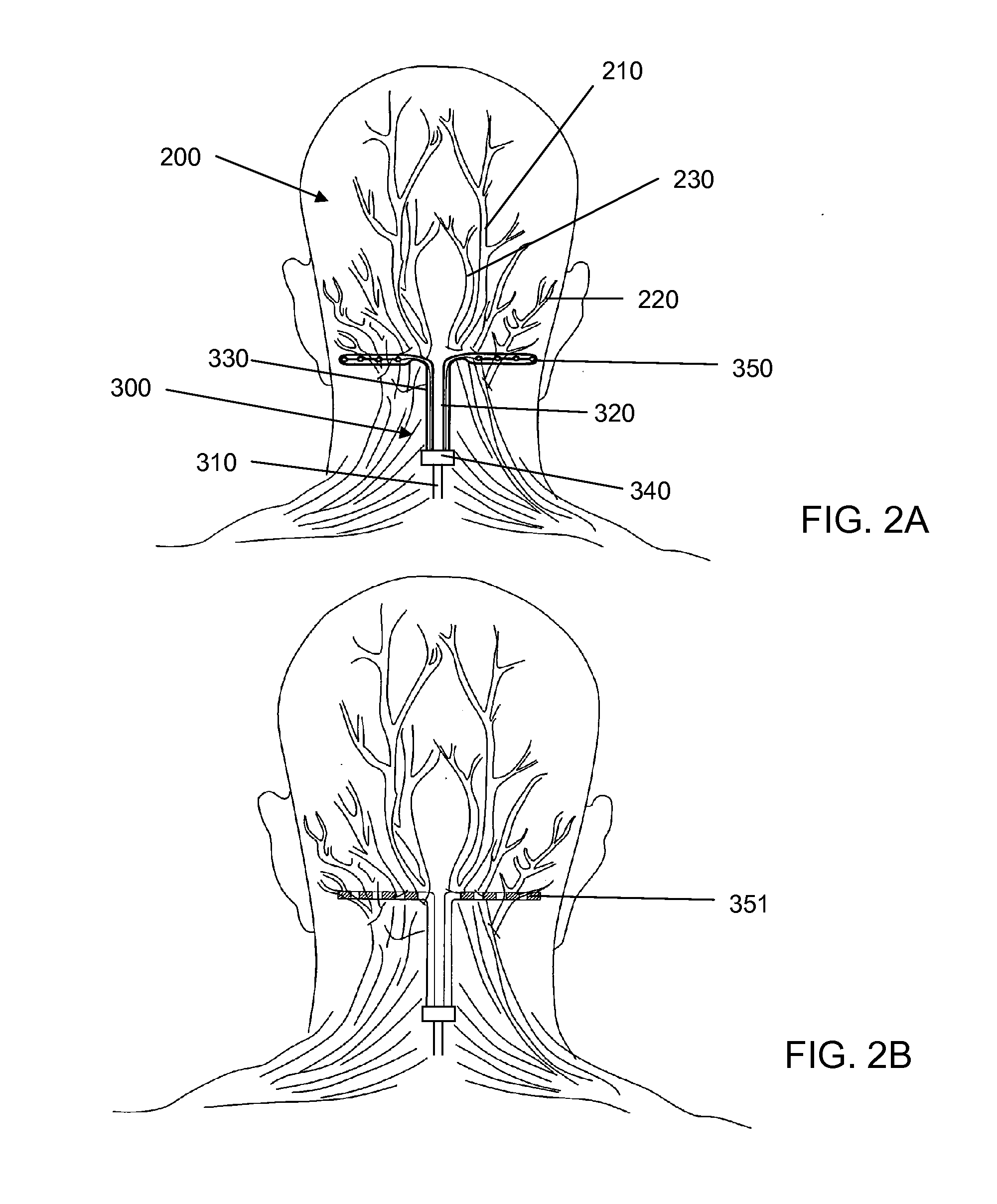 Bifurcated lead system and apparatus