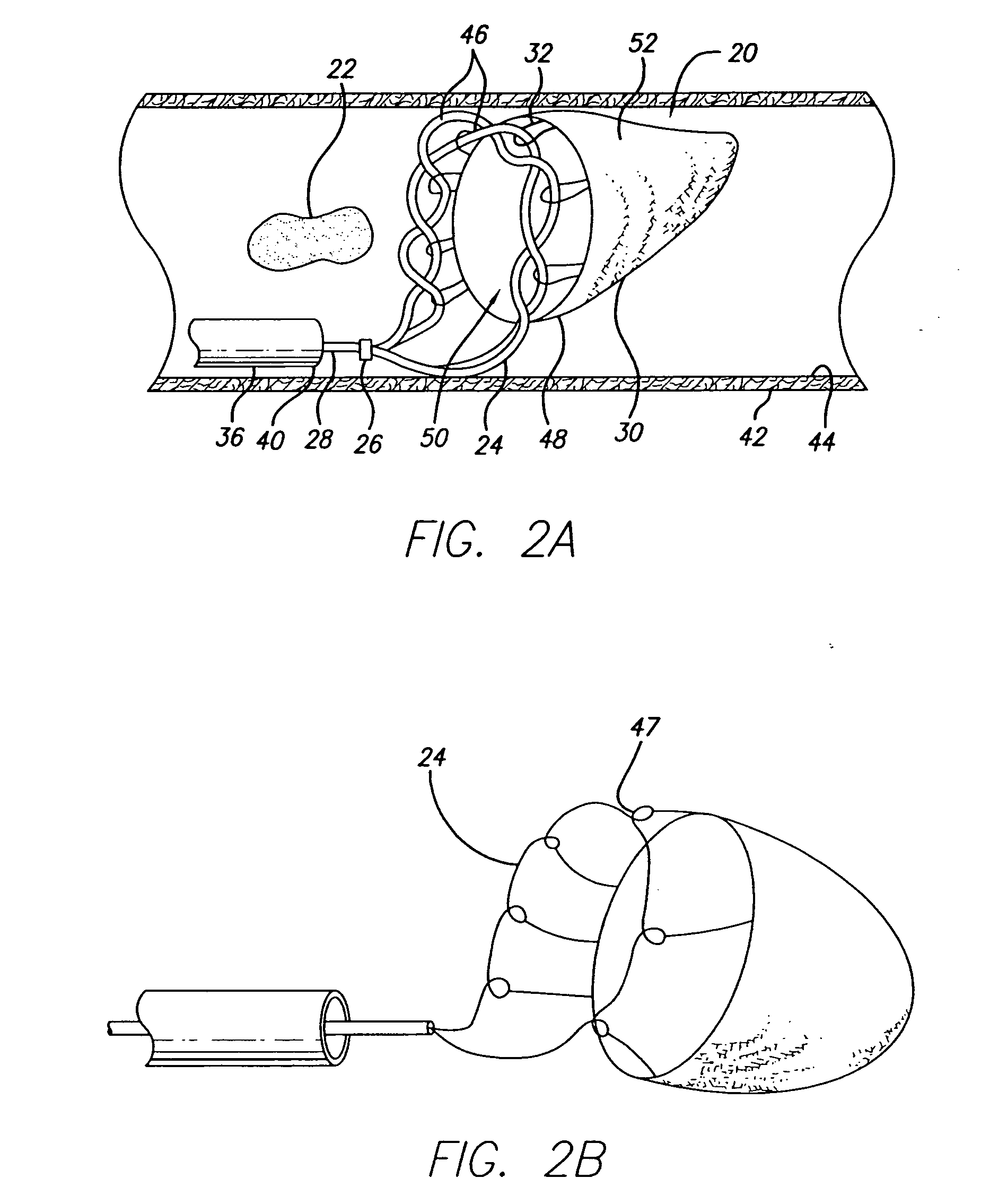 Expandable emboli filter and thrombectomy device