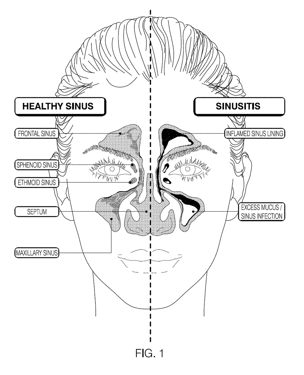 Devices and methods for diagnosis of sinusitis