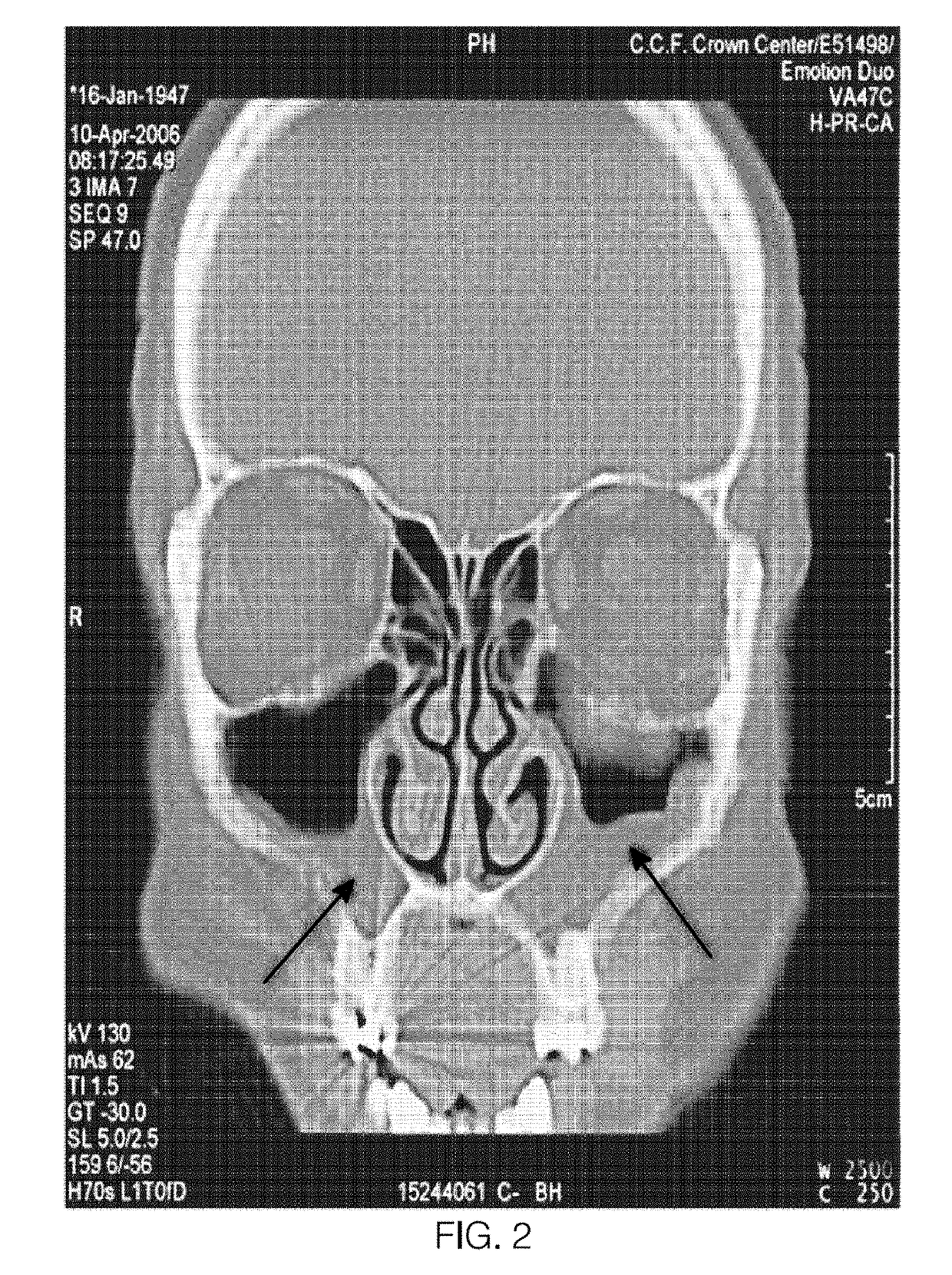 Devices and methods for diagnosis of sinusitis