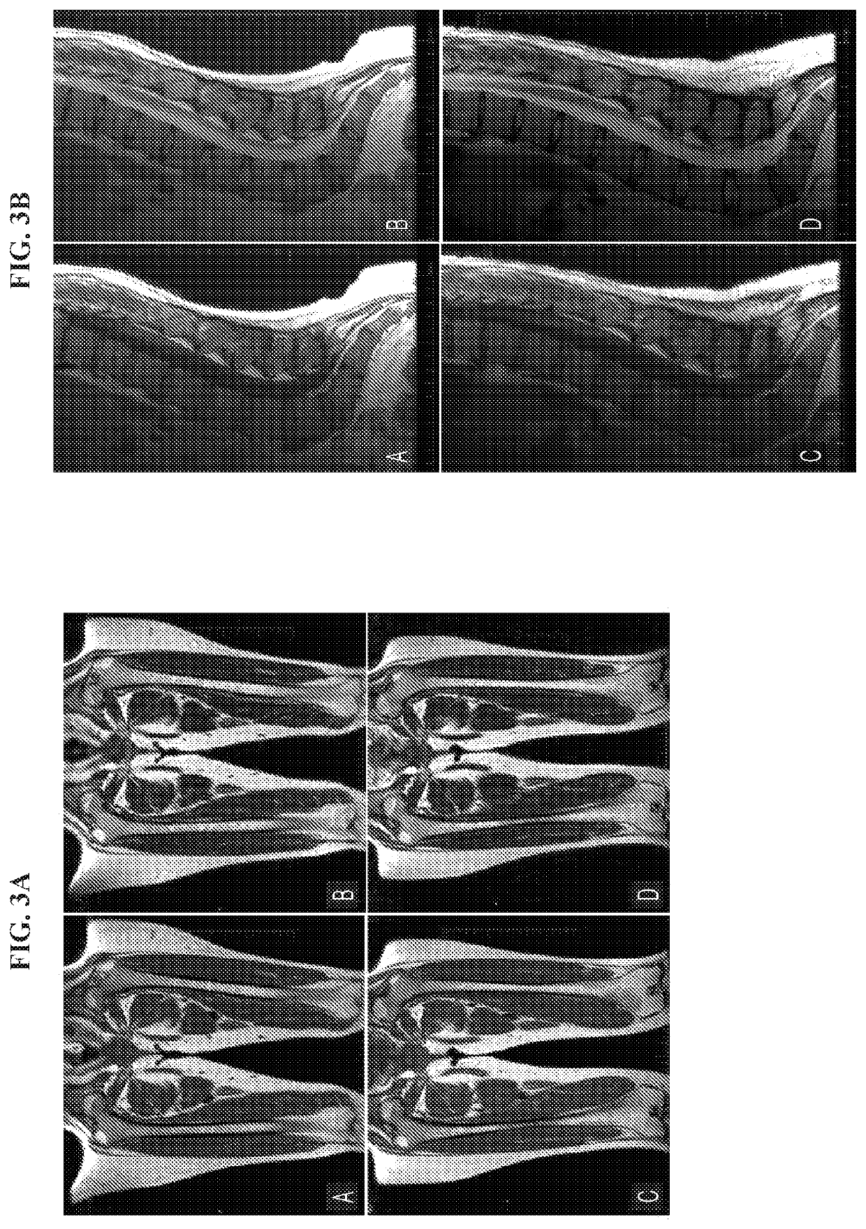 Treatment of abnormal bone conditions in acid sphingomyelinase deficiency patients