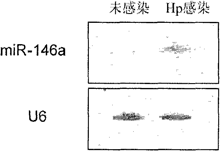 Application of miR-146a in preparing medicine for curing gastricism