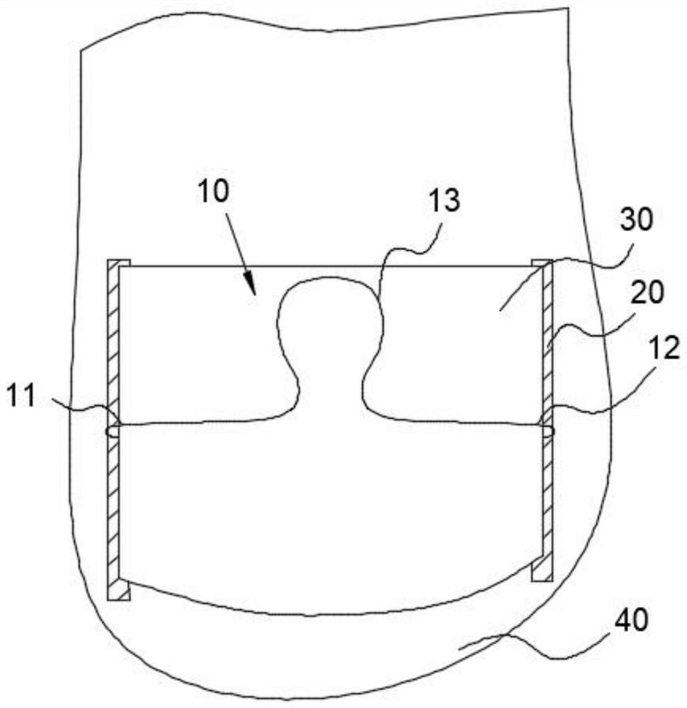 Omega steel wire orthopedic device and orthopedic method for ingrown nail on foot