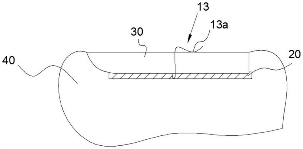 Omega steel wire orthopedic device and orthopedic method for ingrown nail on foot