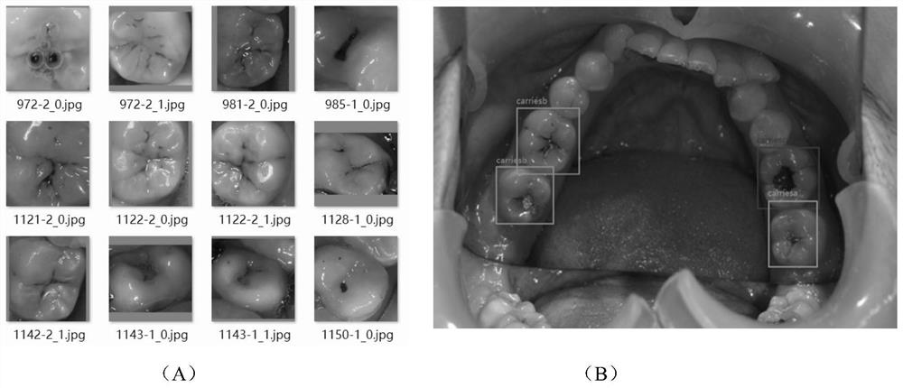 Color image caries recognition method based on deep learning