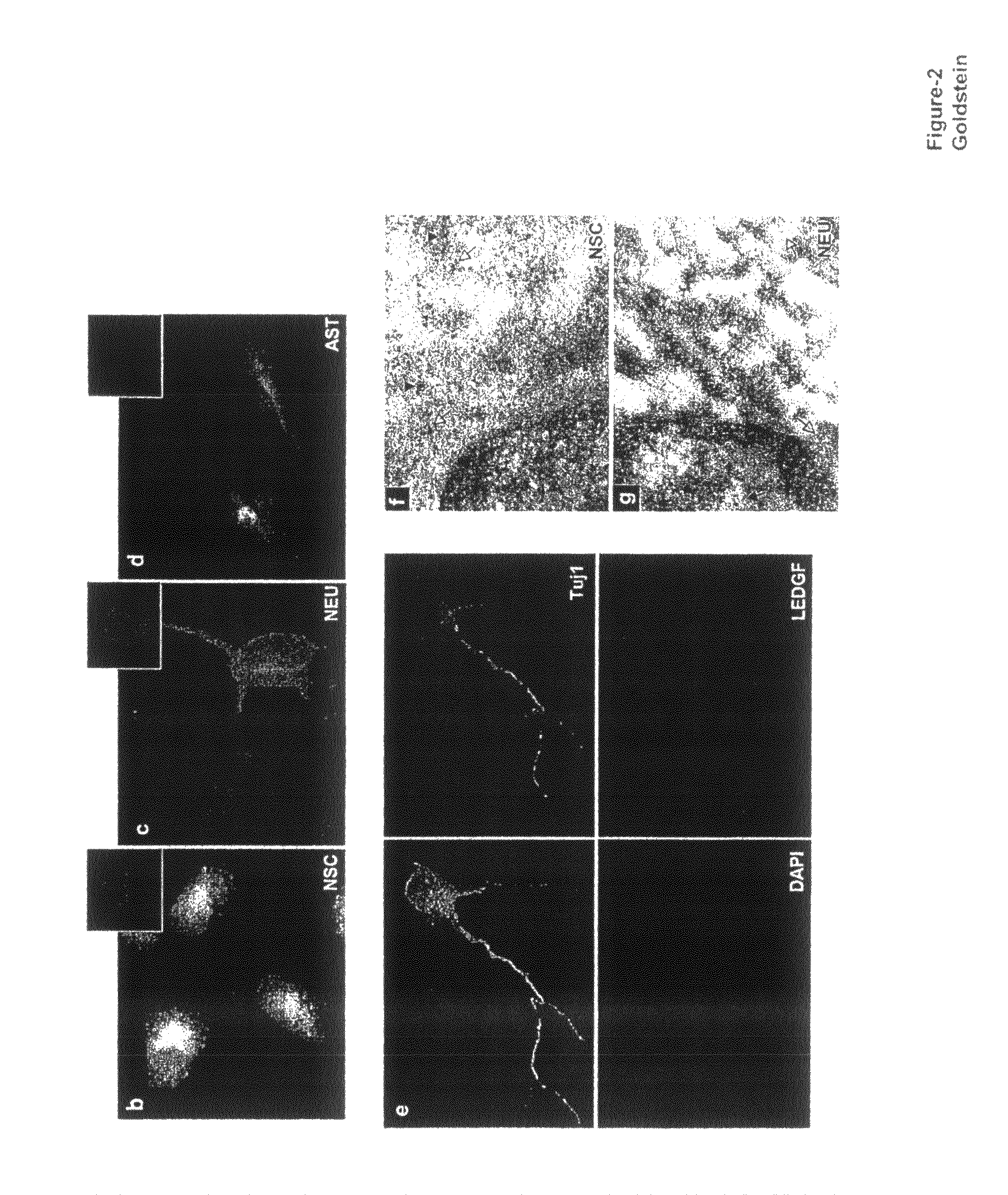 Compositions and methods for diagnosing tumors using LEDGF/p75