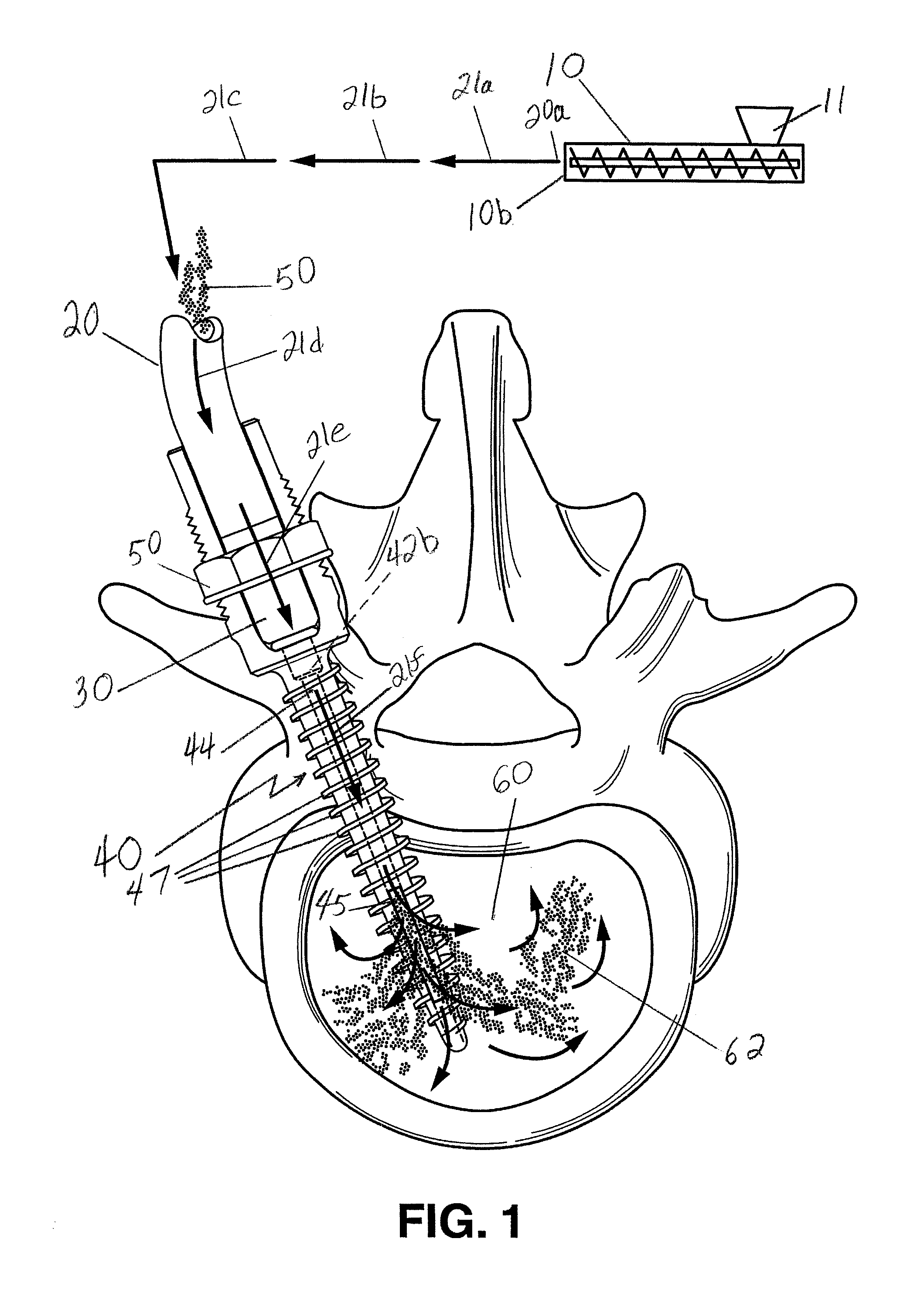 Method and apparatus for anchoring bone screws and injecting many types of high viscosity materials in areas surrounding bone