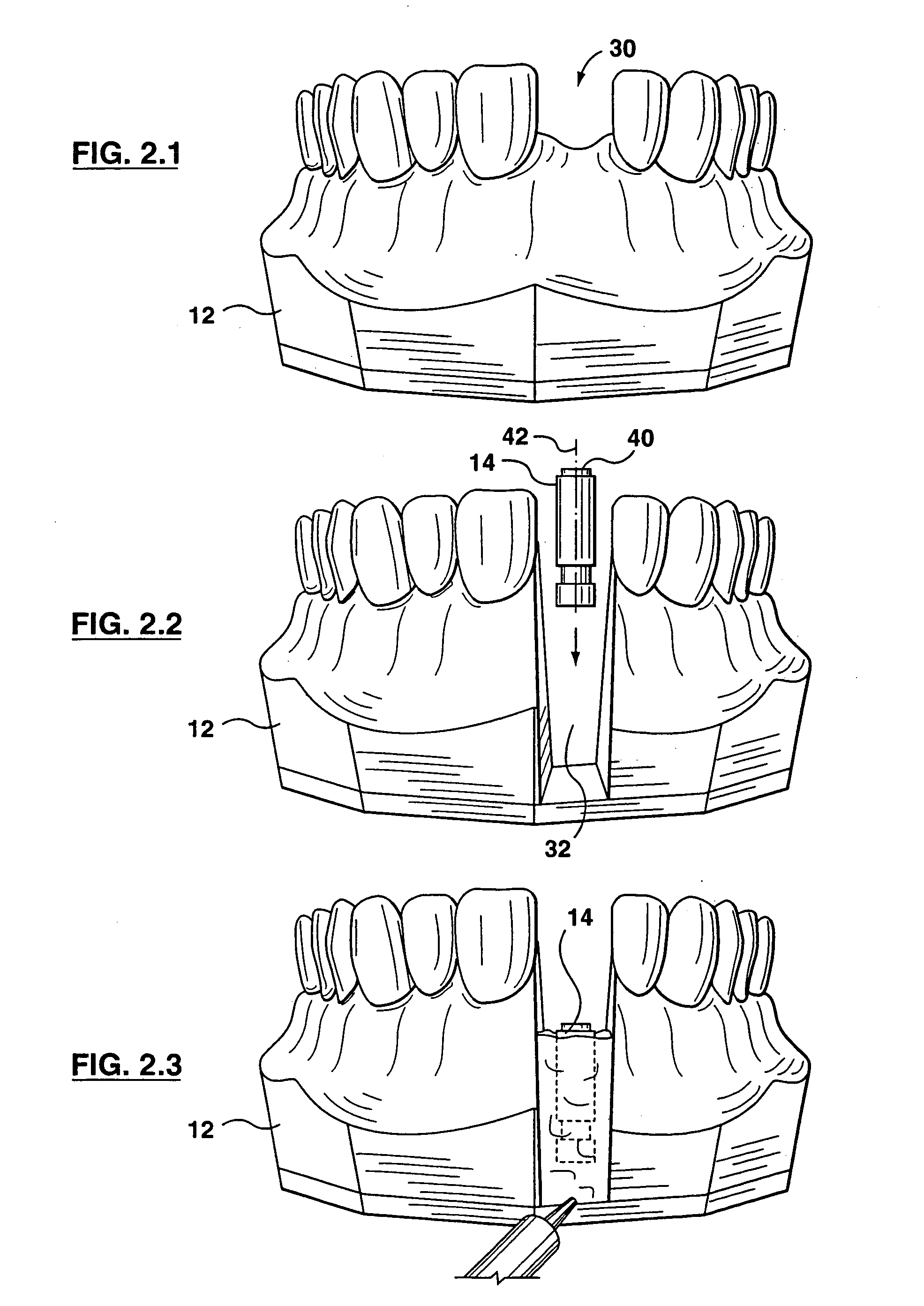 Implant positioning device and method