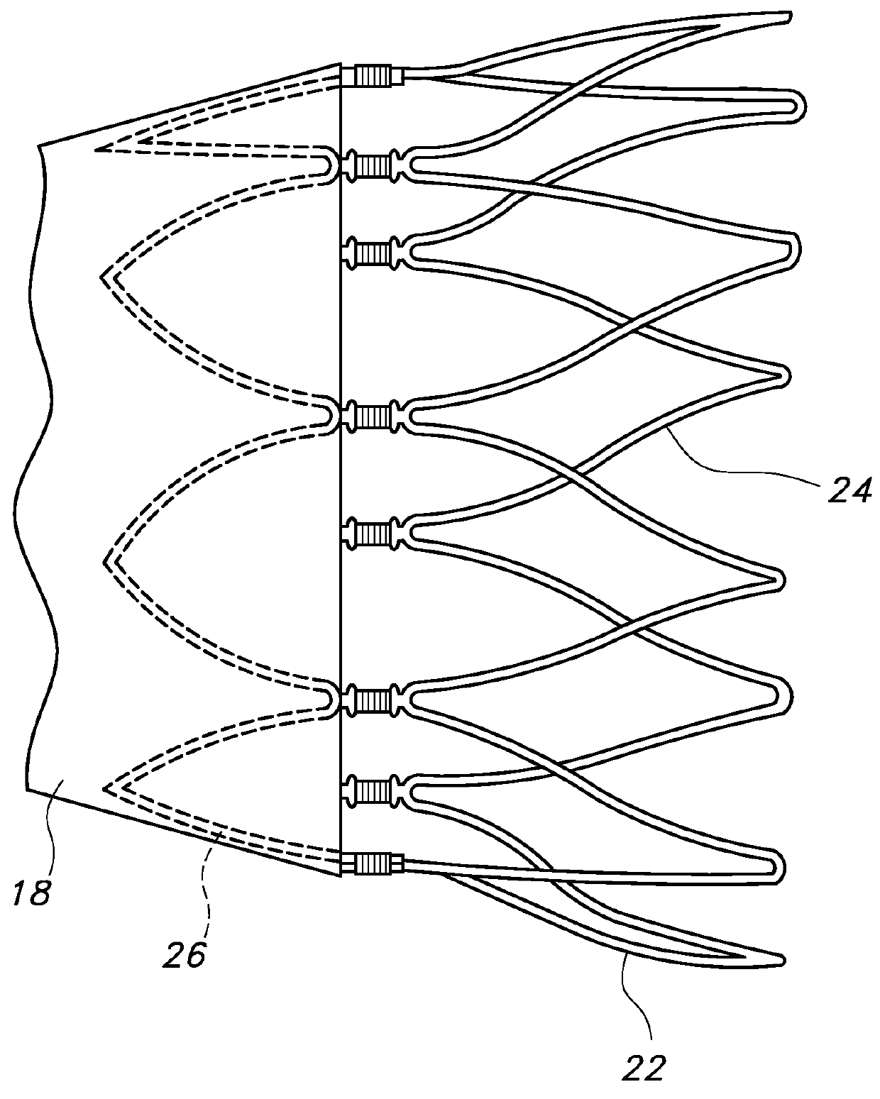 Advanced kink resistant stent graft