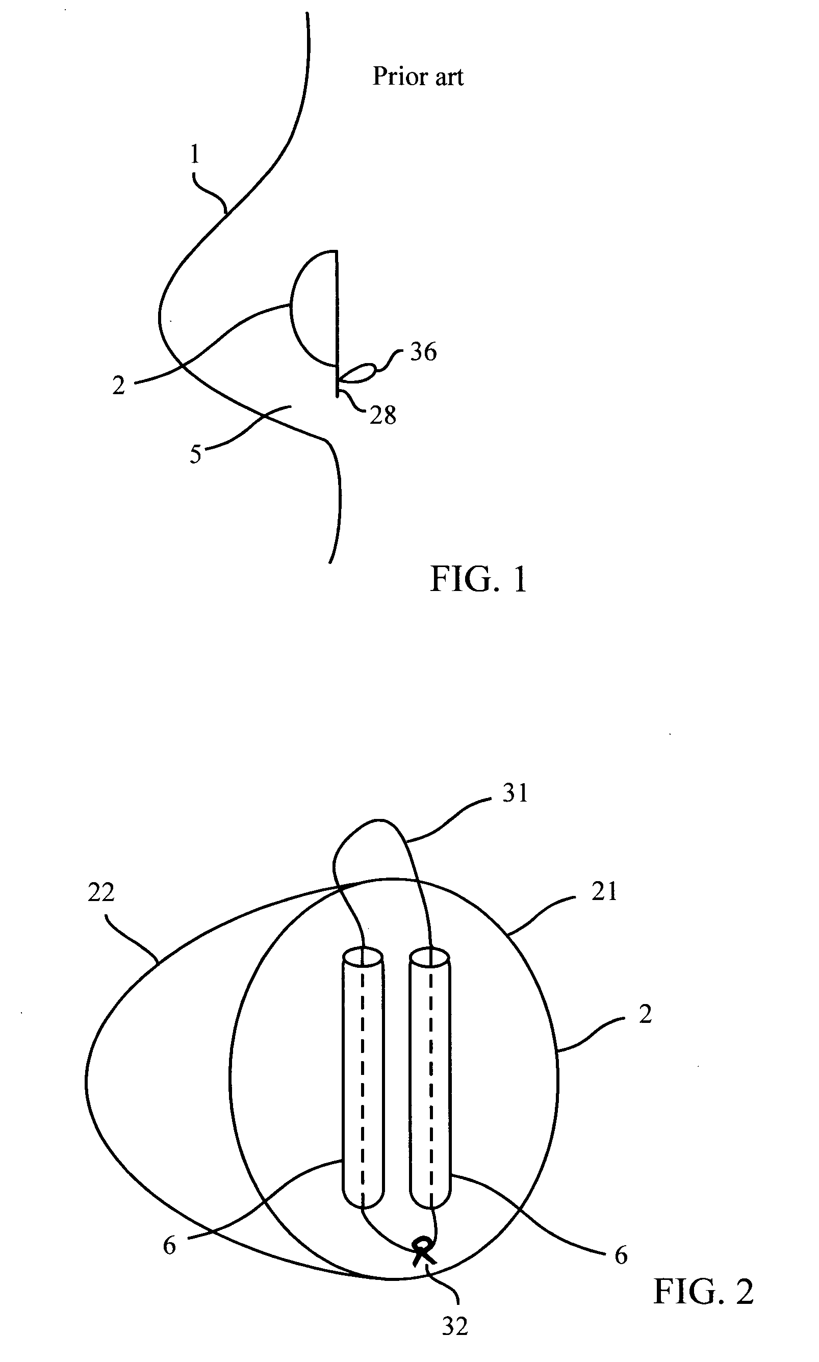 Implant device and method