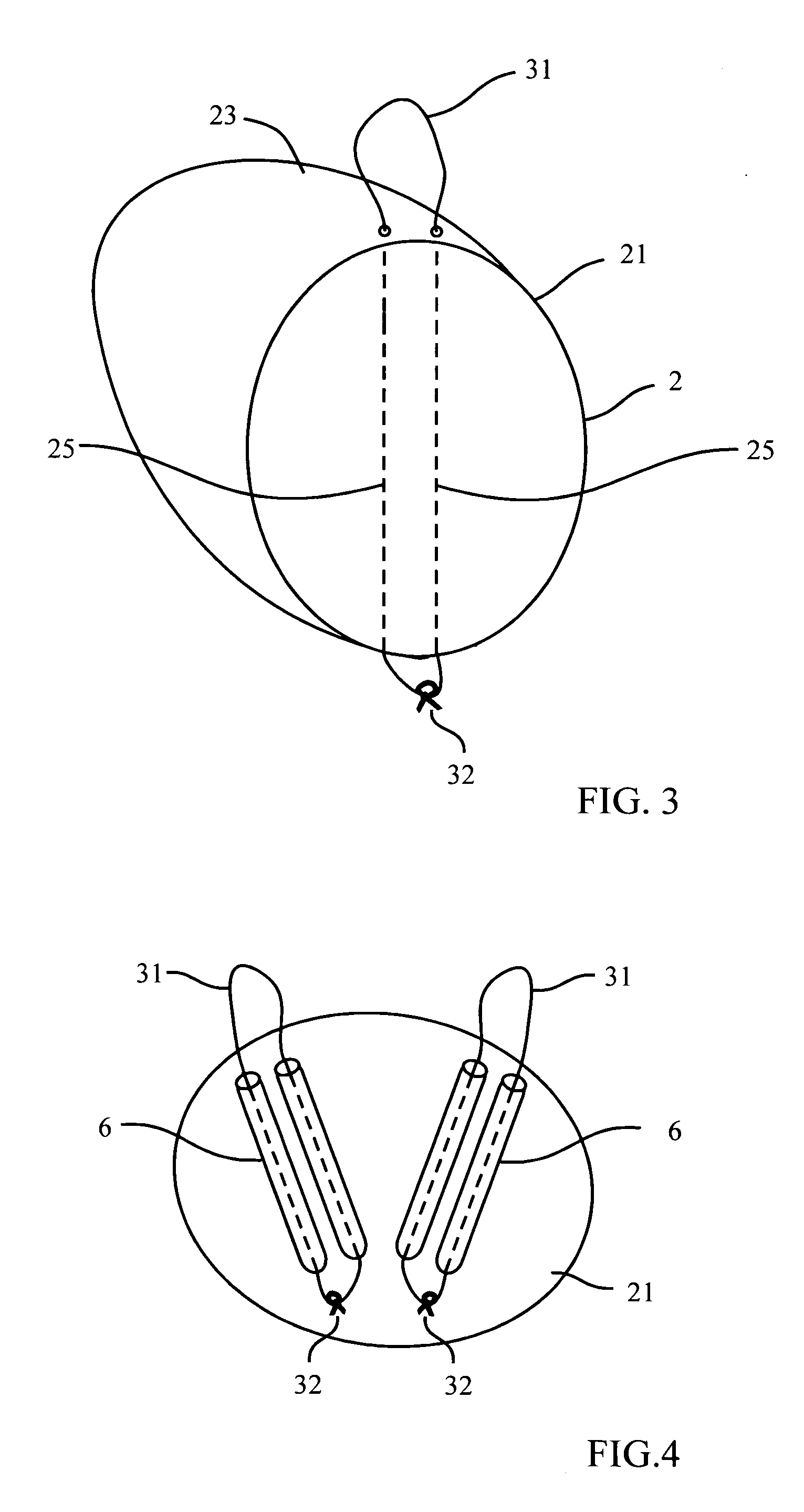 Implant device and method