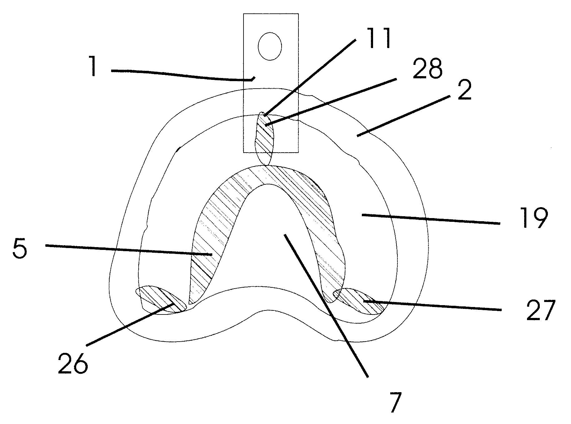 No Distortion Impression Tray and Method of Use