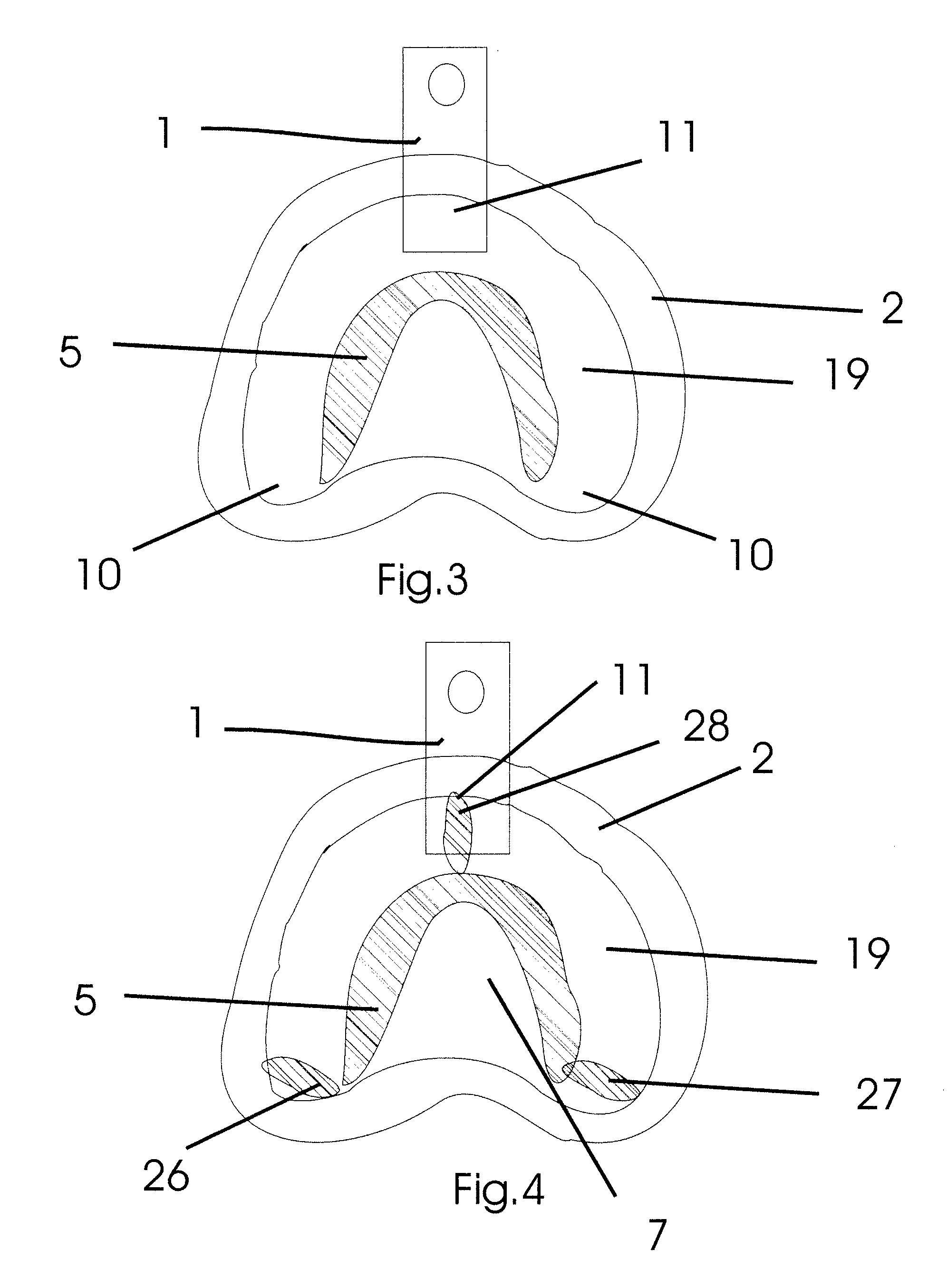 No Distortion Impression Tray and Method of Use