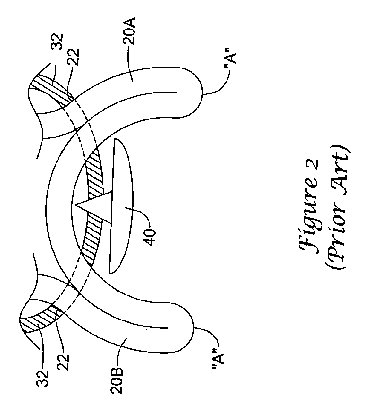 Plug for arteriotomy closure and method of use