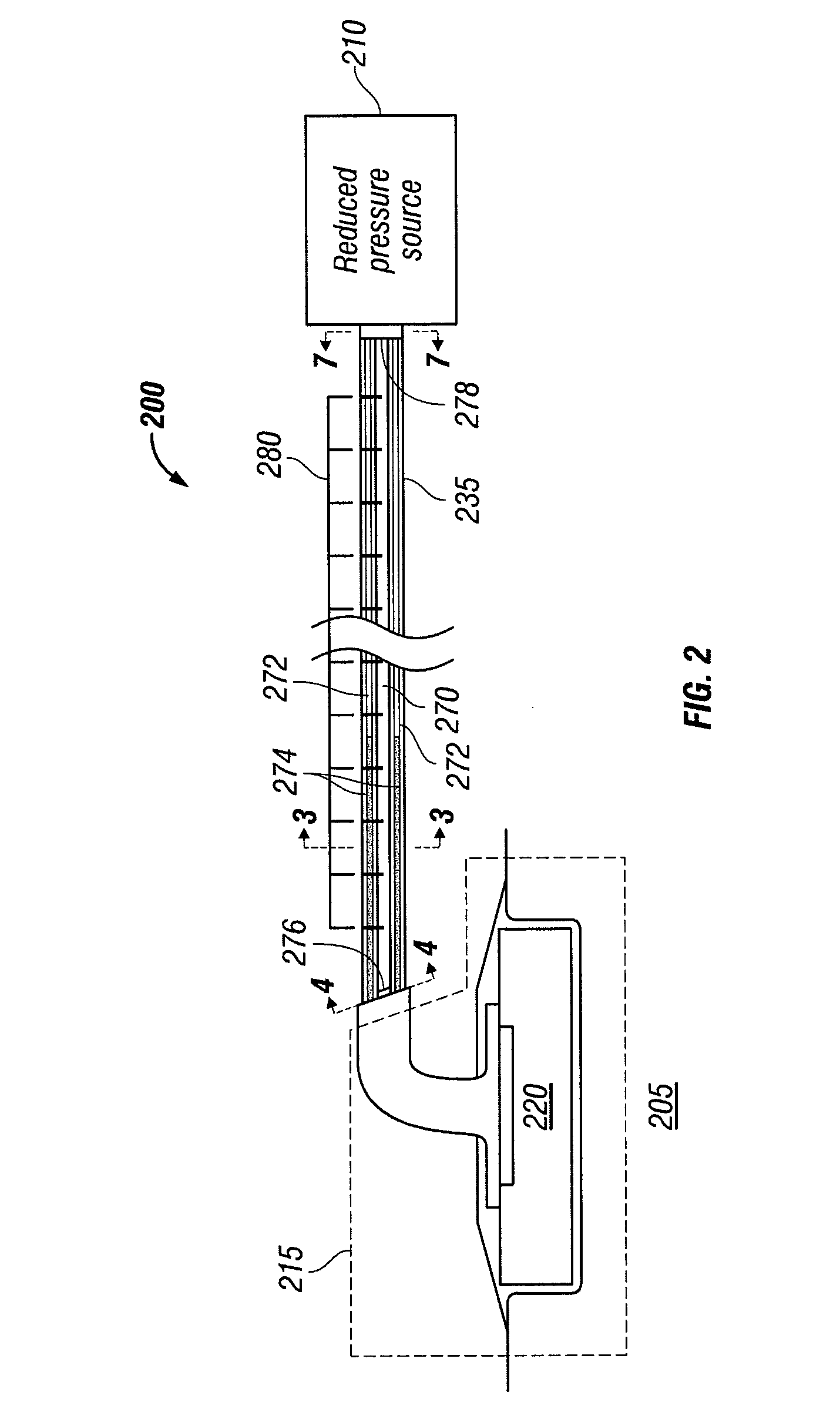 Apparatus and method for administering reduced pressure treatment to a tissue site