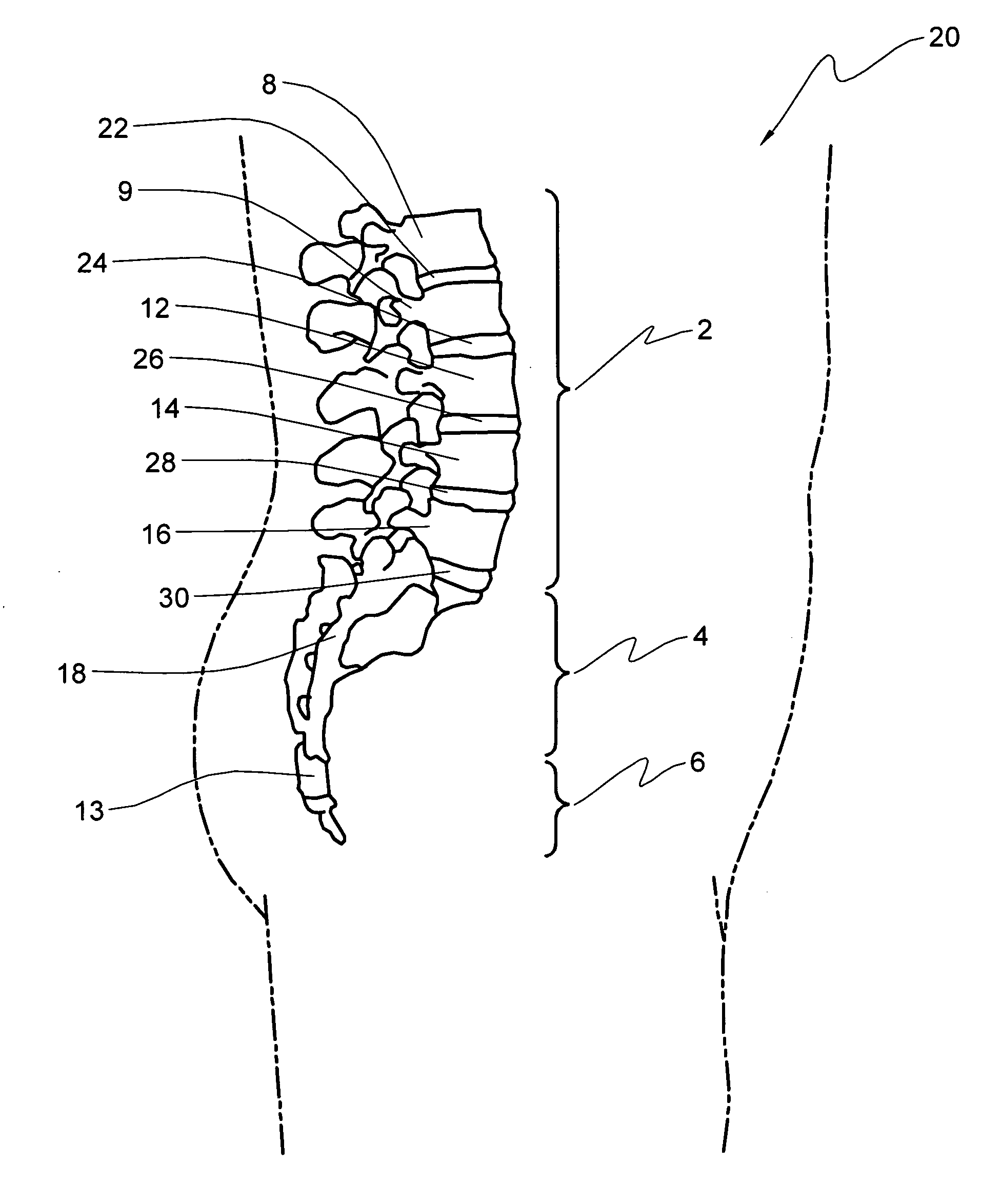 Systems and methods for adjusting properties of a spinal implant