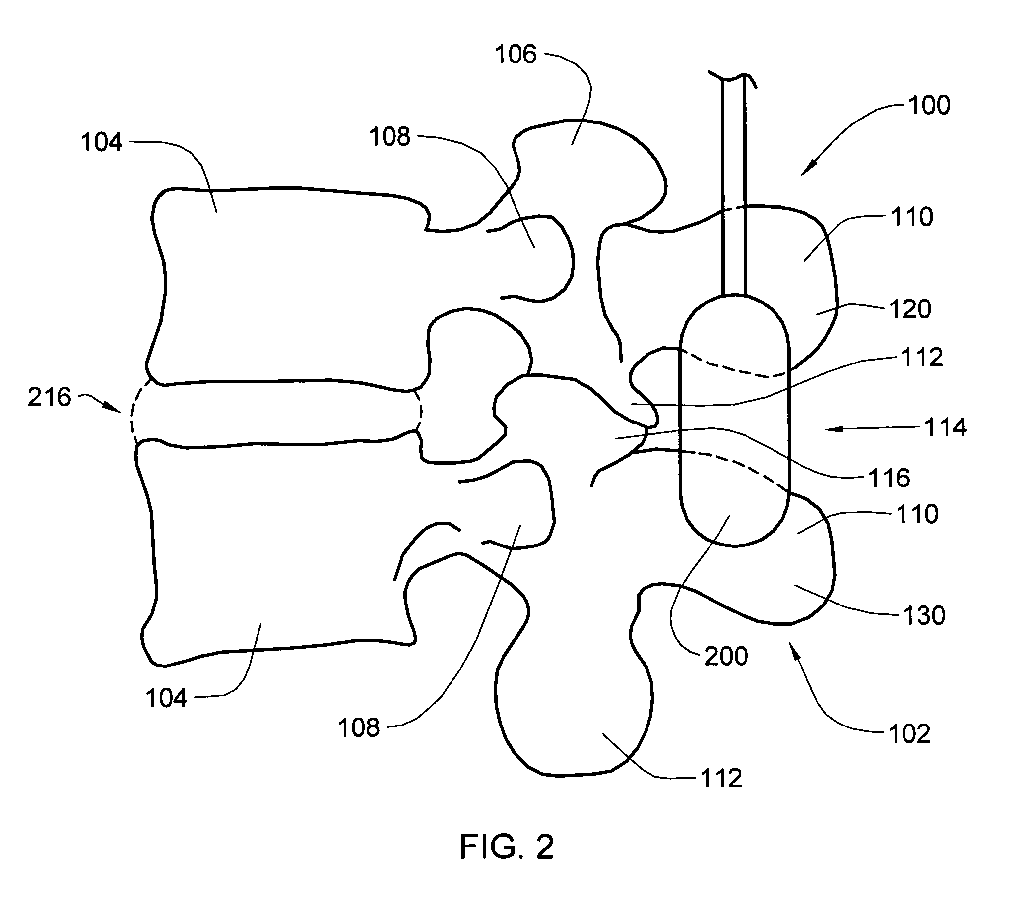 Systems and methods for adjusting properties of a spinal implant