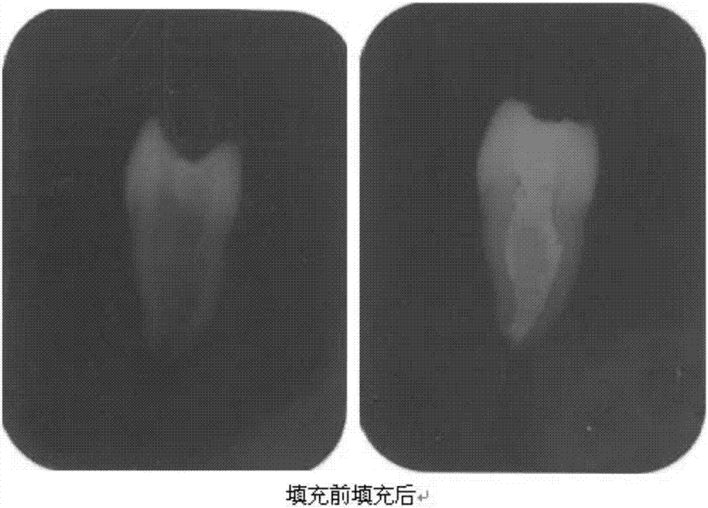 Premixed calcium silicate based root canal filling material with suspension stability as well as preparation method and application thereof