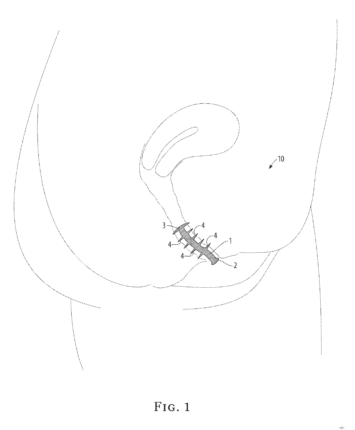 Vaginal barrier device apparatus and method