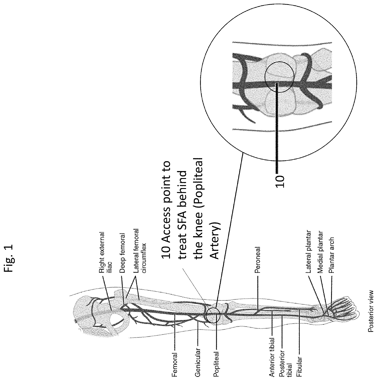 System and method for treatment of the claudification of the superficial femoral and proximal popliteal artery