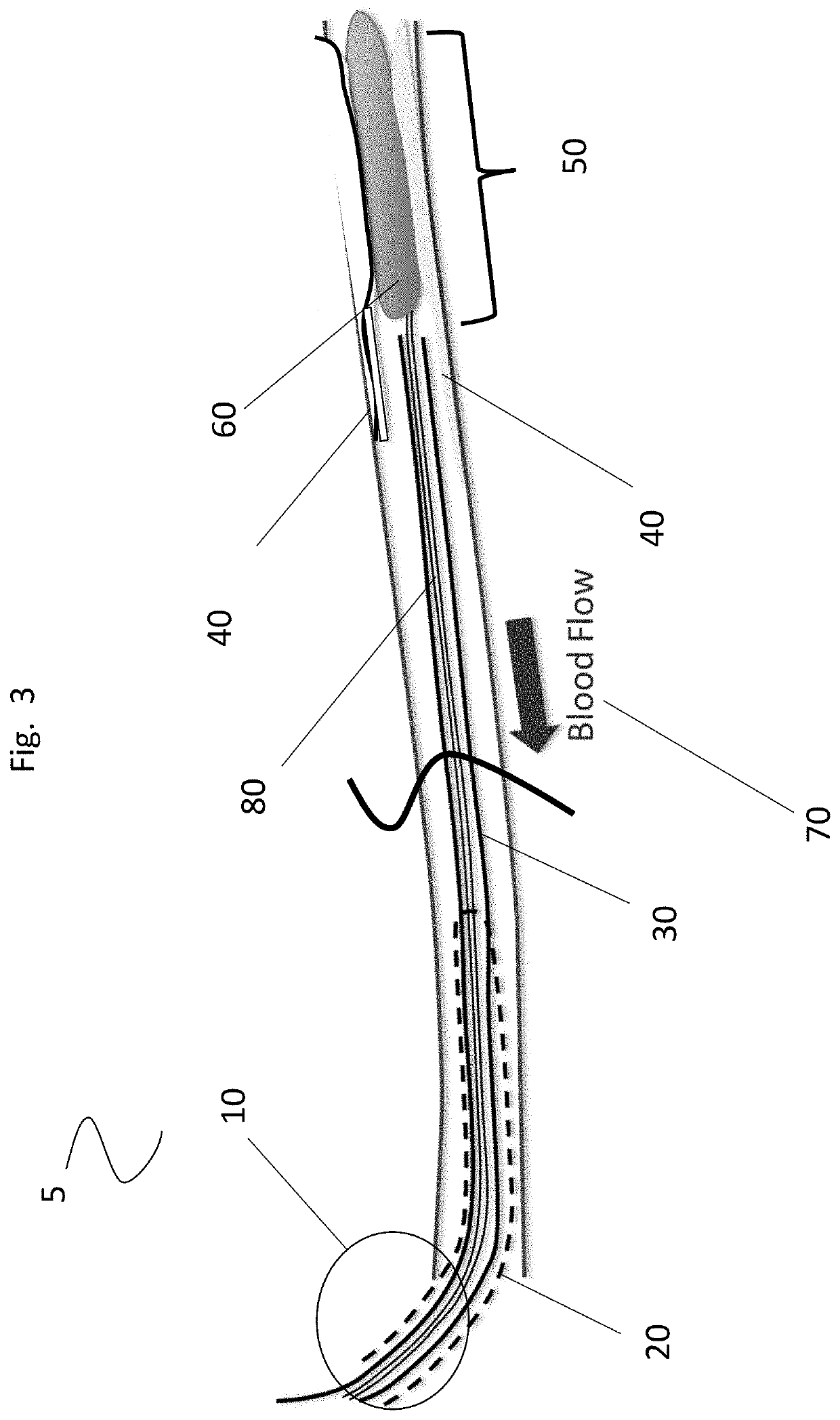 System and method for treatment of the claudification of the superficial femoral and proximal popliteal artery