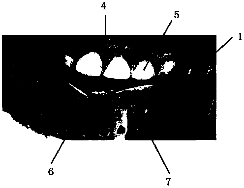 Impression method for accurately copying gingival pattern