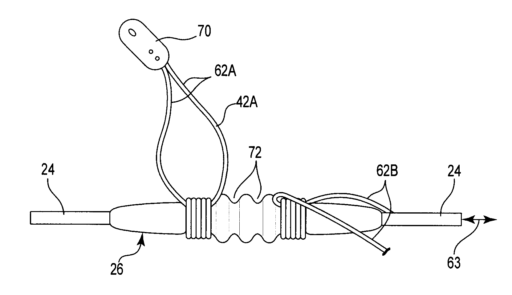 Pre-sutured anchor for implantable leads