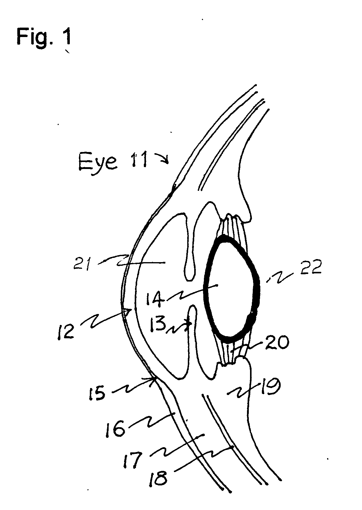 Method and system for non-invasive treatment of hyperopia, presbyopia and glaucoma