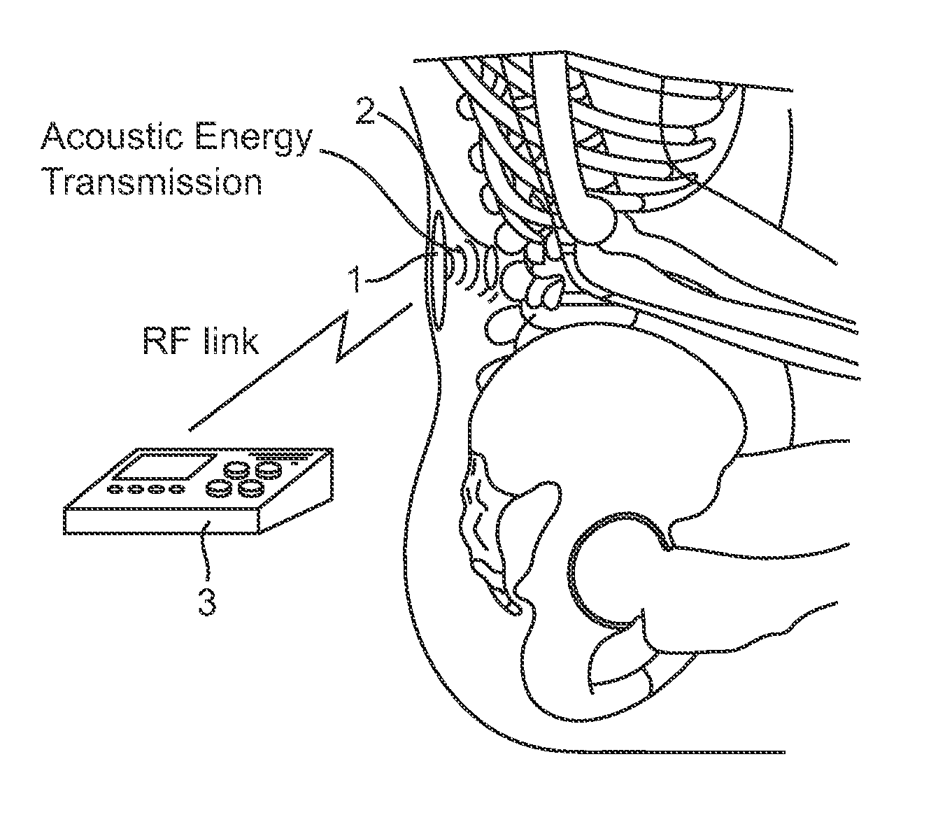 Systems and methods for implantable leadless spine stimulation