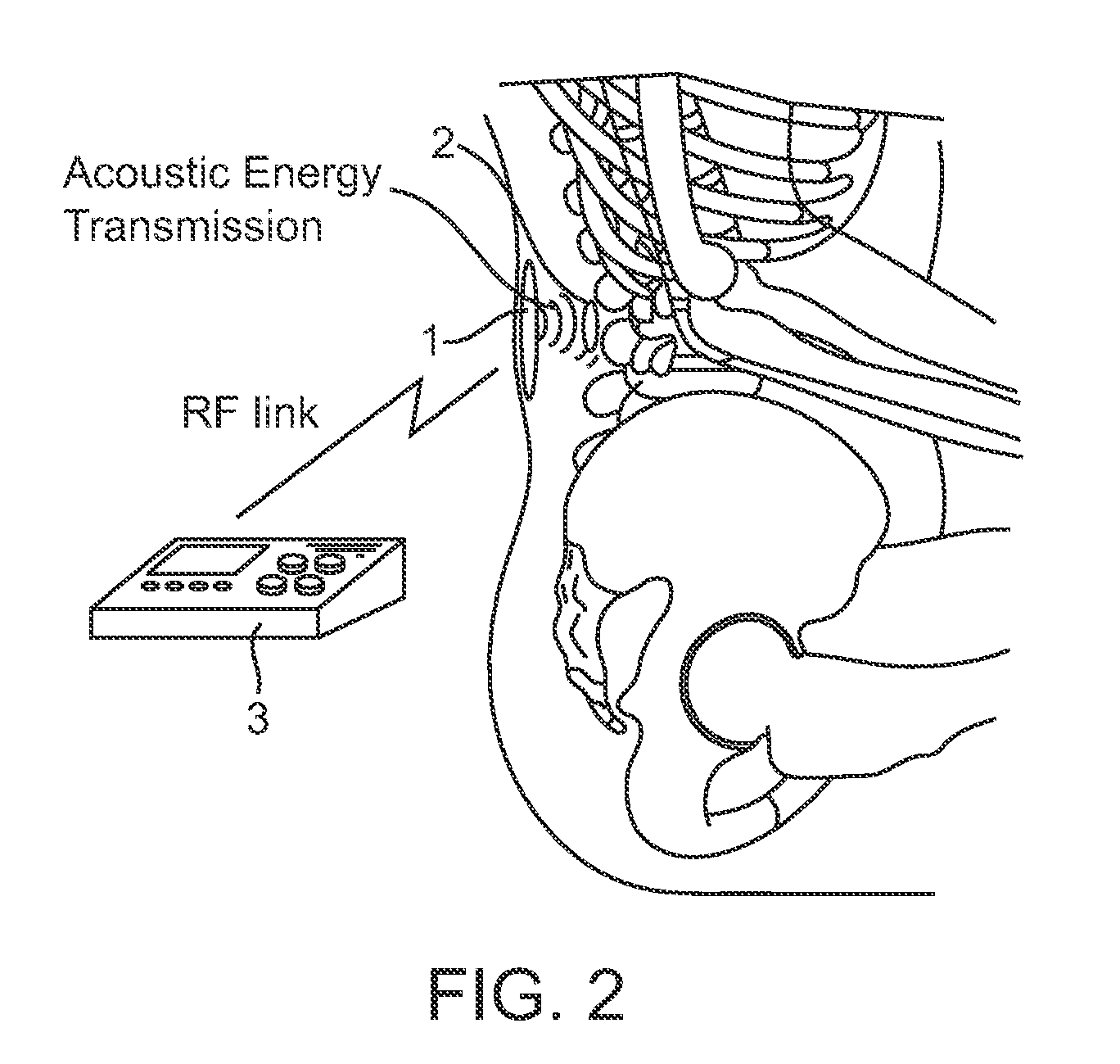 Systems and methods for implantable leadless spine stimulation