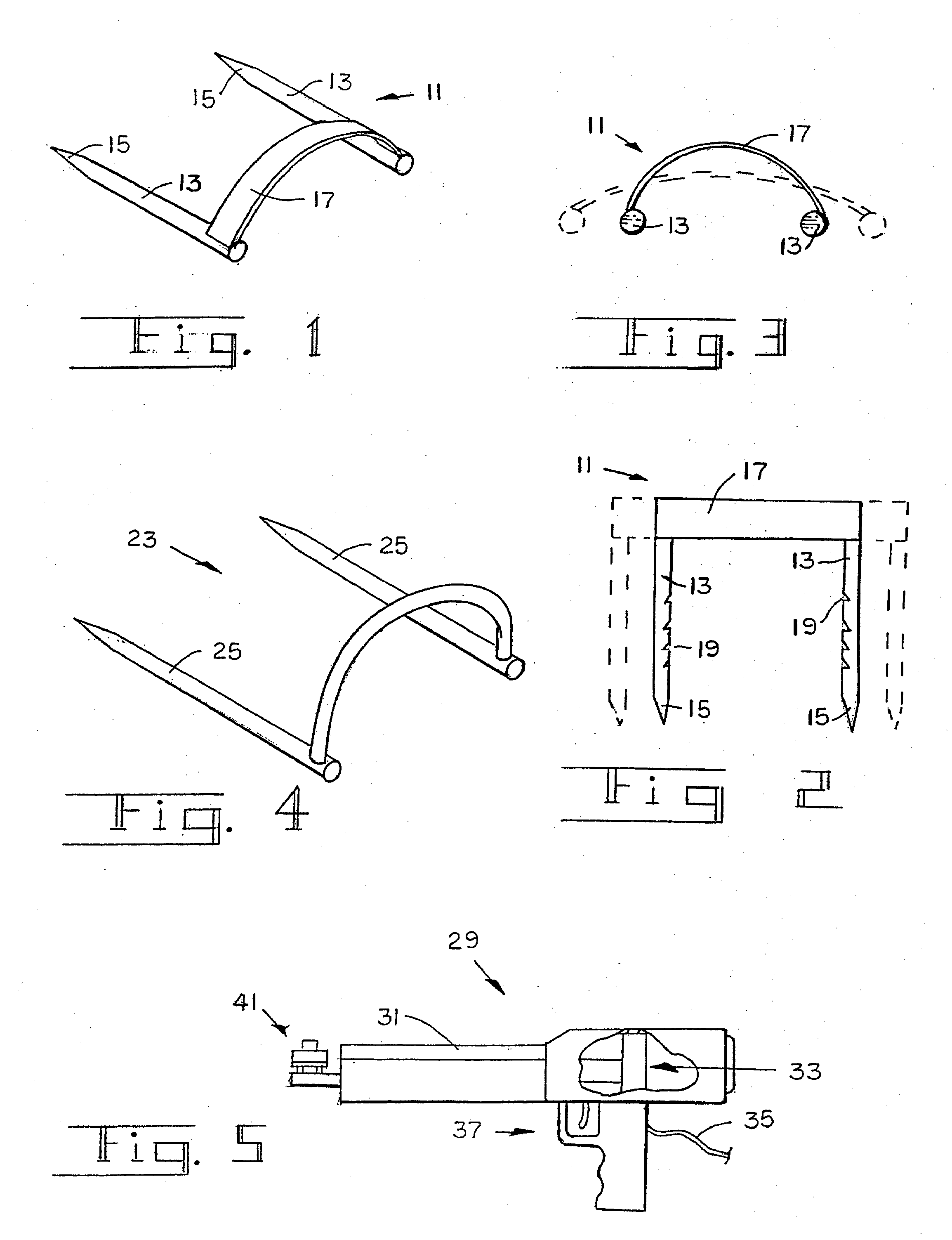 Compression bone staple, apparatus and method of the invention