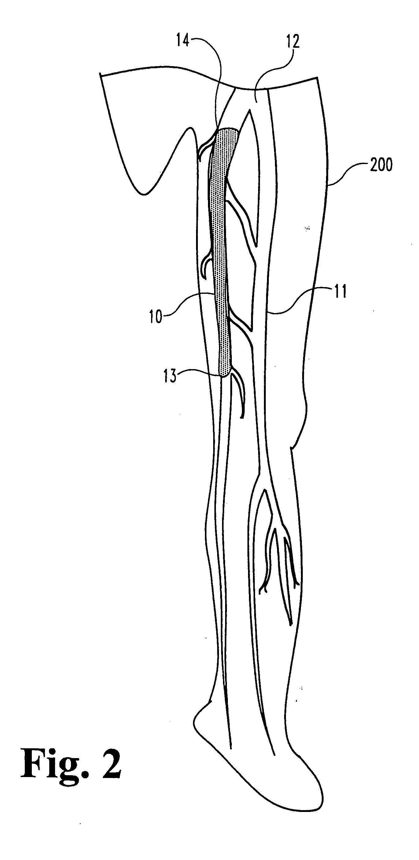 Vascular occlusion methods, systems and devices