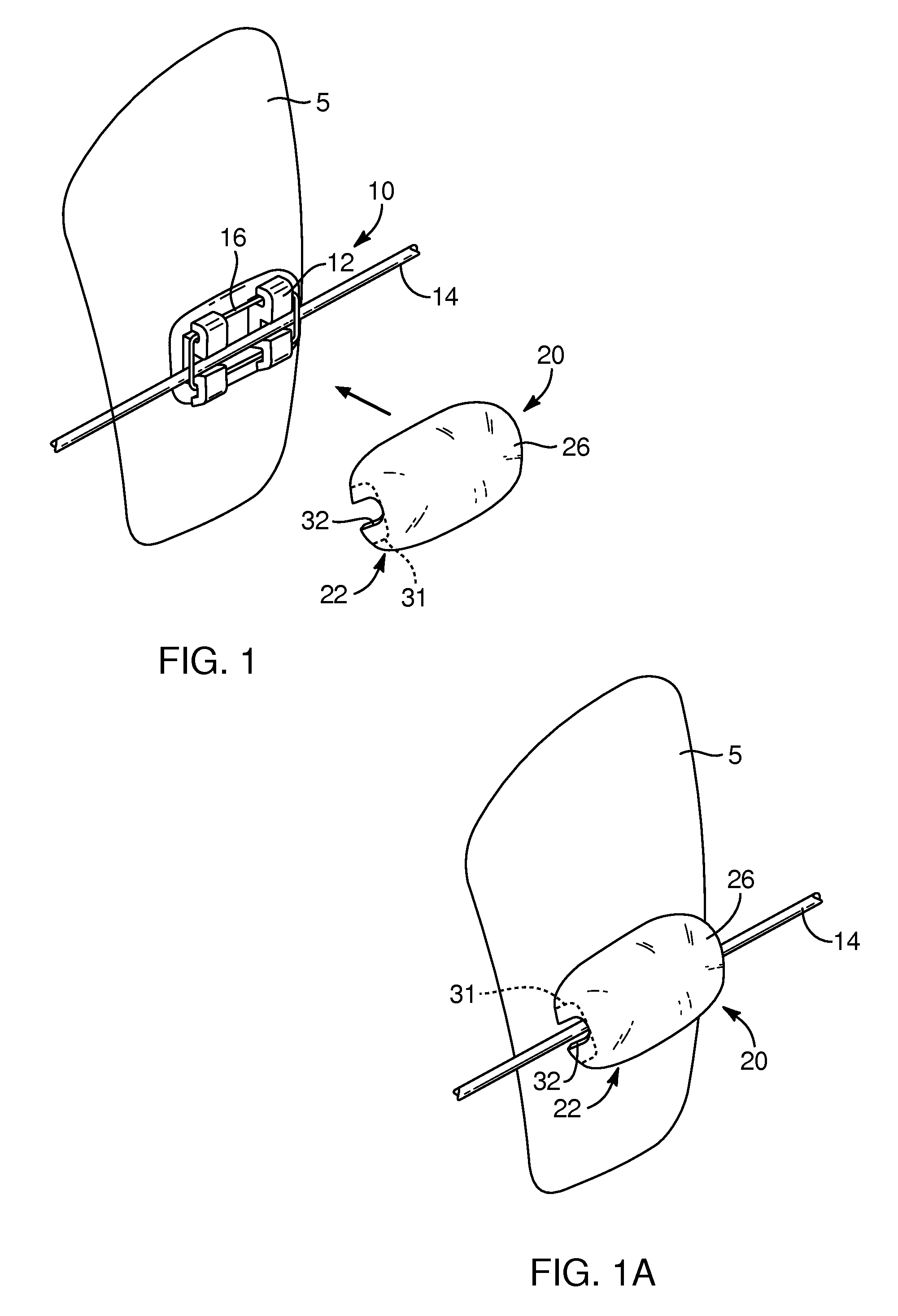 Devices, systems, and methods for orthodontic hardware