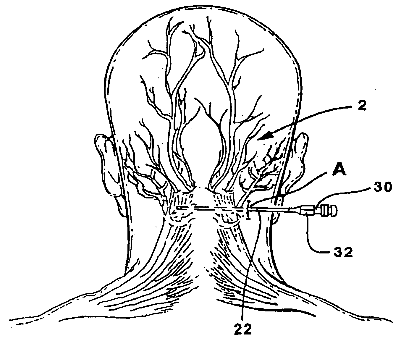 Peripheral nerve stimulation