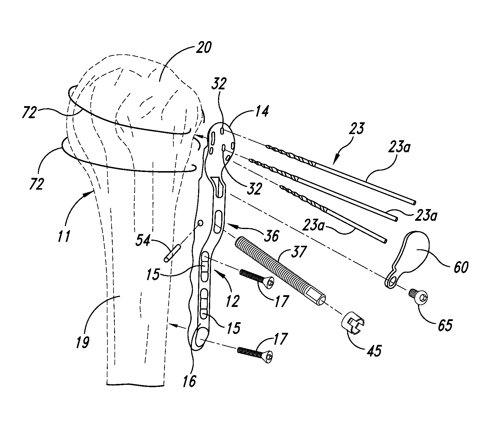 Device for the ostheosynthesis of proximal humerus fractures