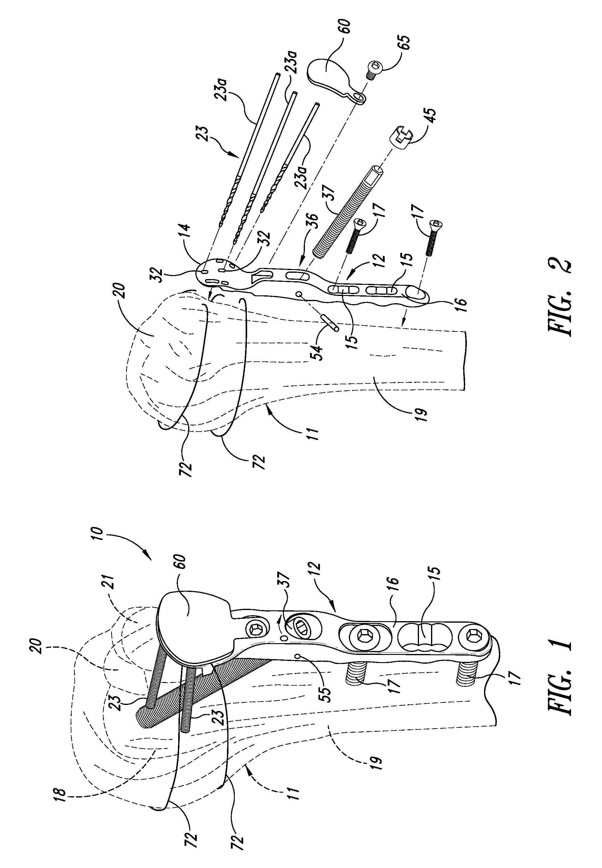 Device for the ostheosynthesis of proximal humerus fractures