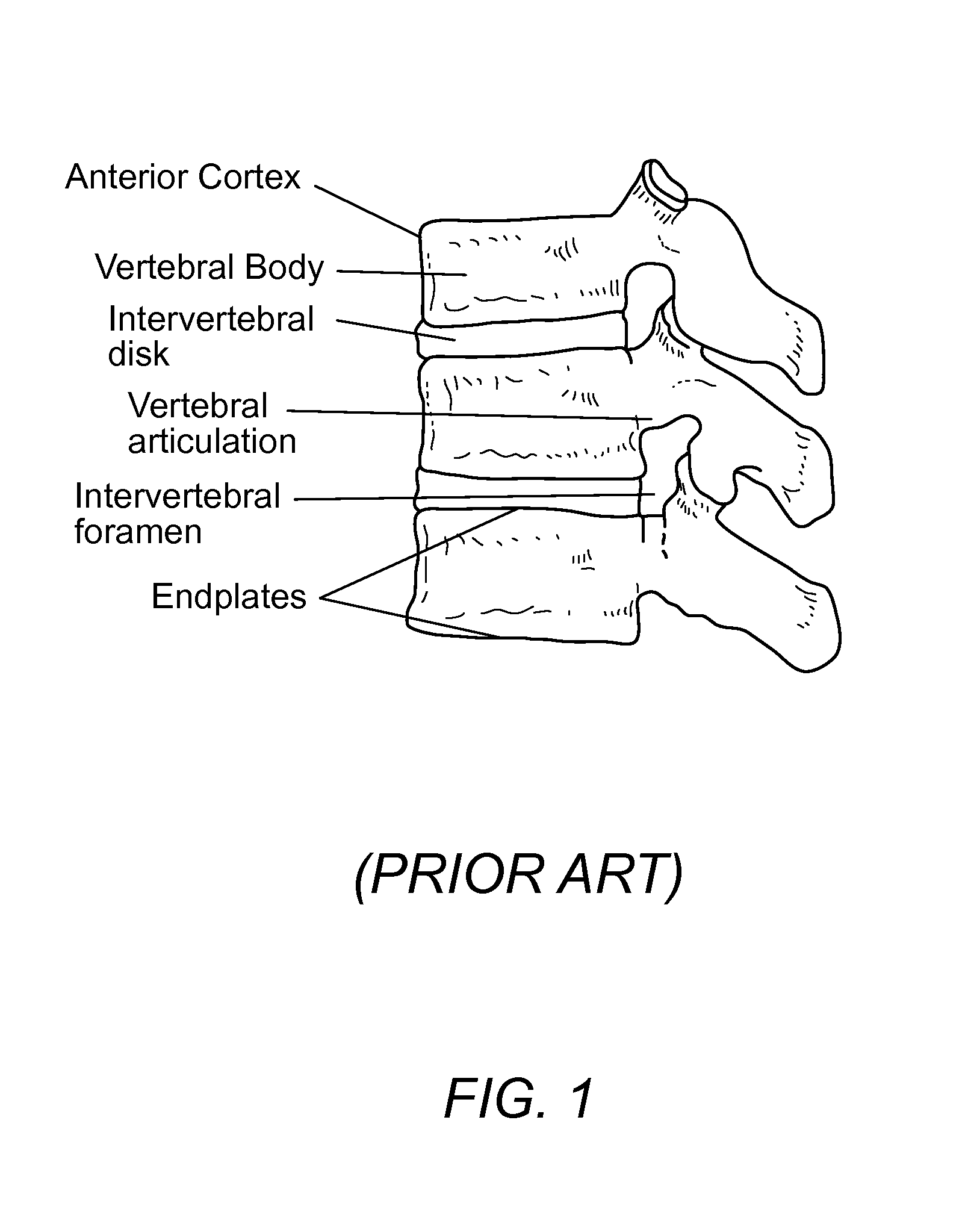 Anterior intervertebral spacer and integrated plate assembly and methods of use