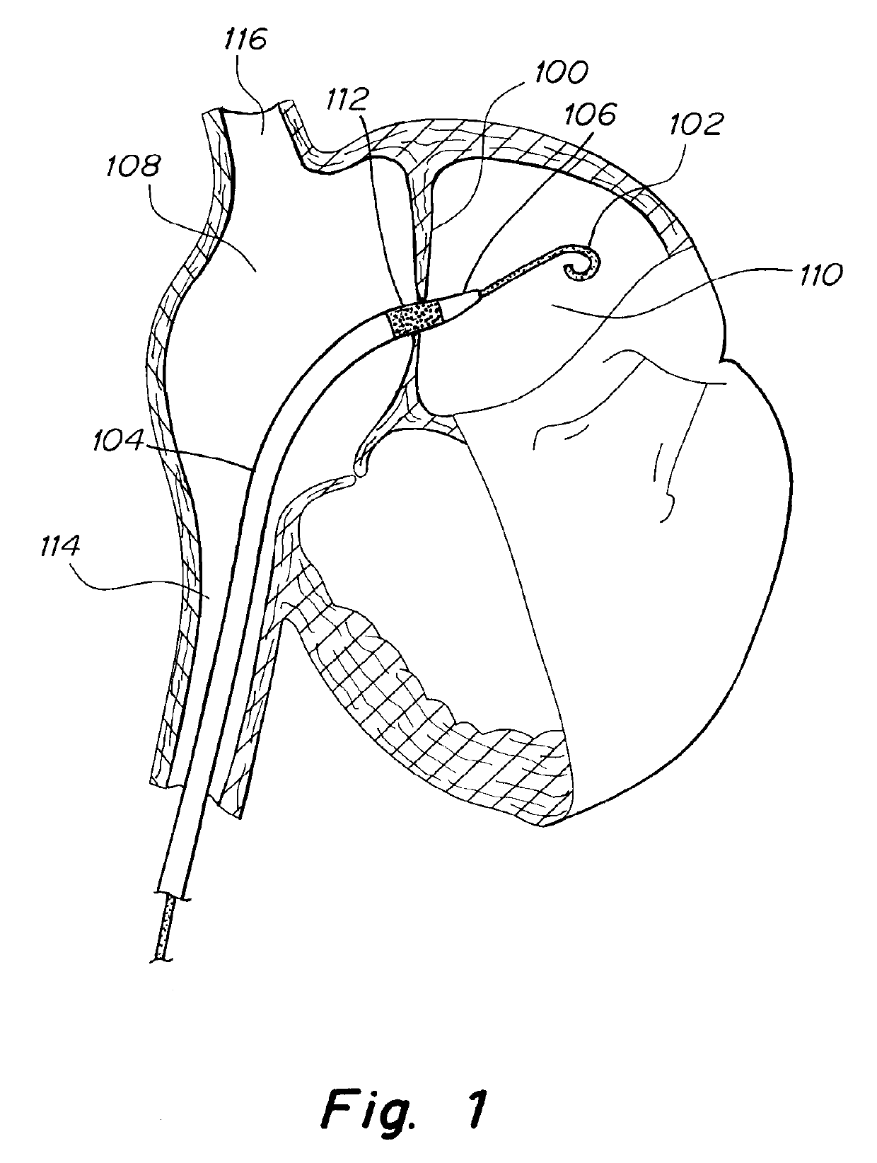 Apparatus and methods to create and maintain an intra-atrial pressure relief opening