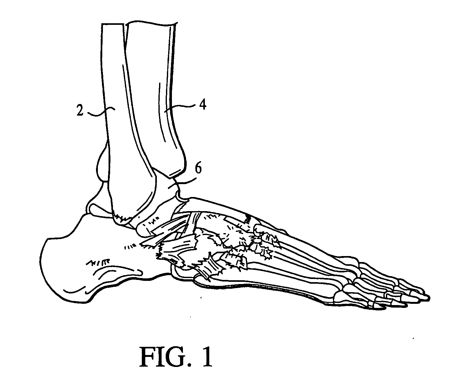 Semi-constrained ankle joint prosthesis and its method of implantation