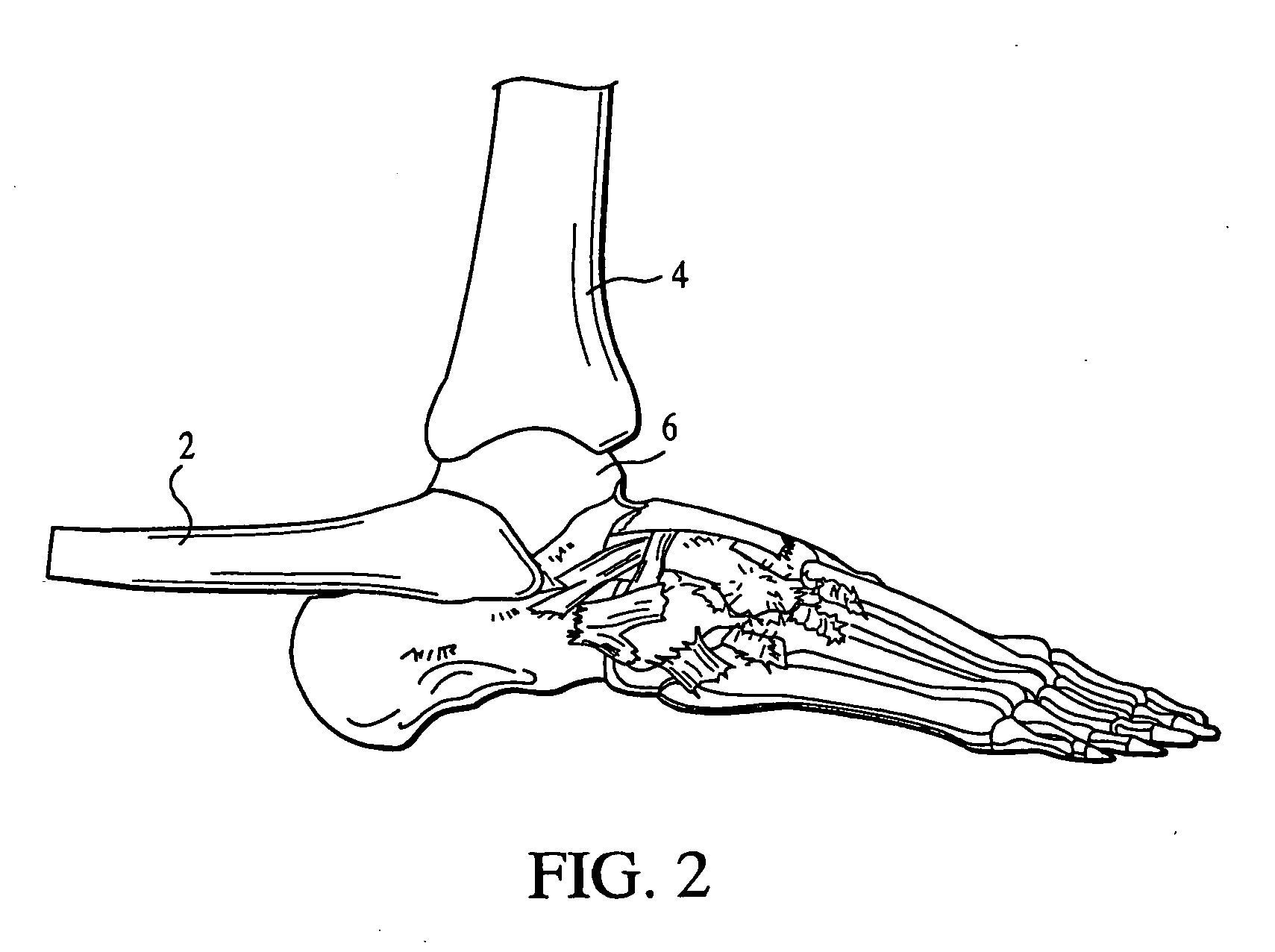 Semi-constrained ankle joint prosthesis and its method of implantation
