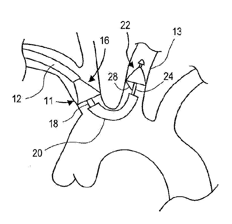 Aortic Embolic Protection Device