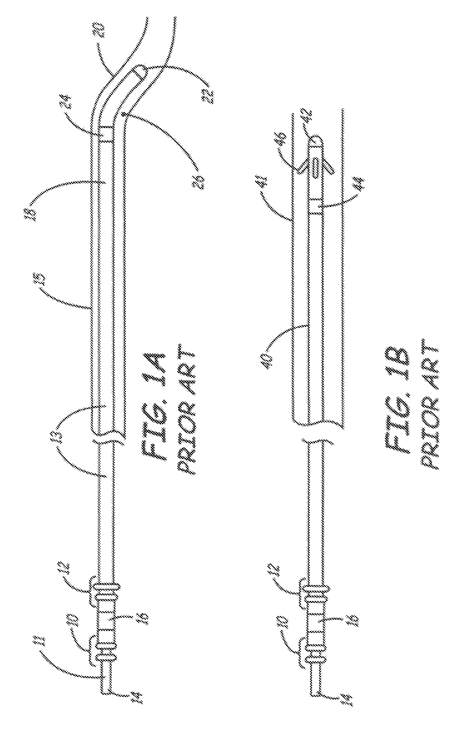 Method of deployable medical lead fixation