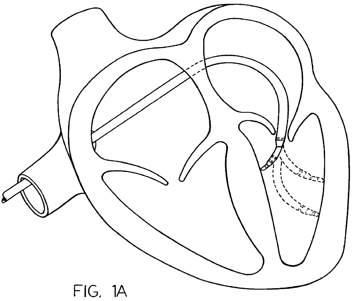 Guiding introducer system for use in medical procedures in the left ventricle