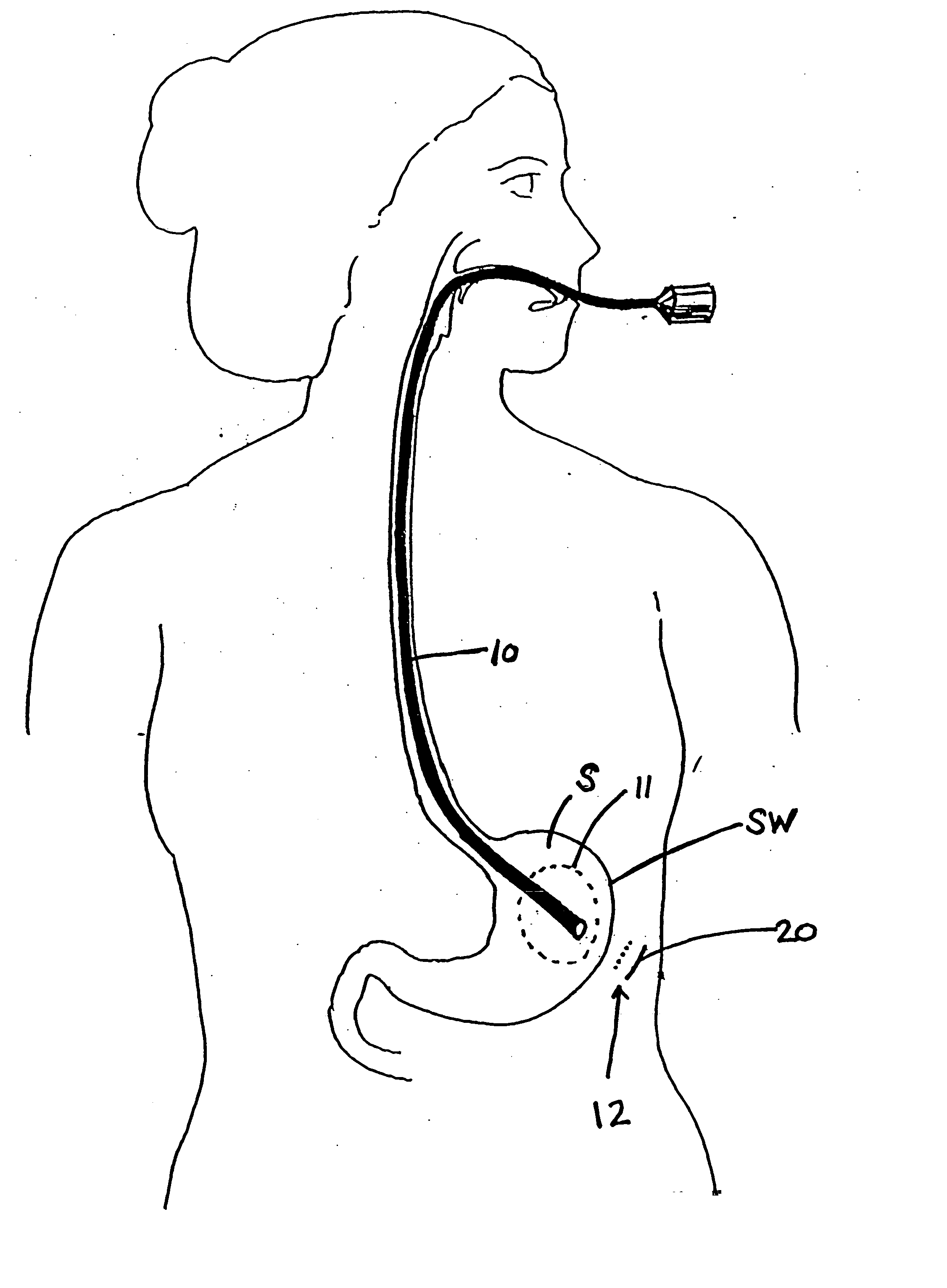 Method and device for use in minimally invasive placement of intragastric devices