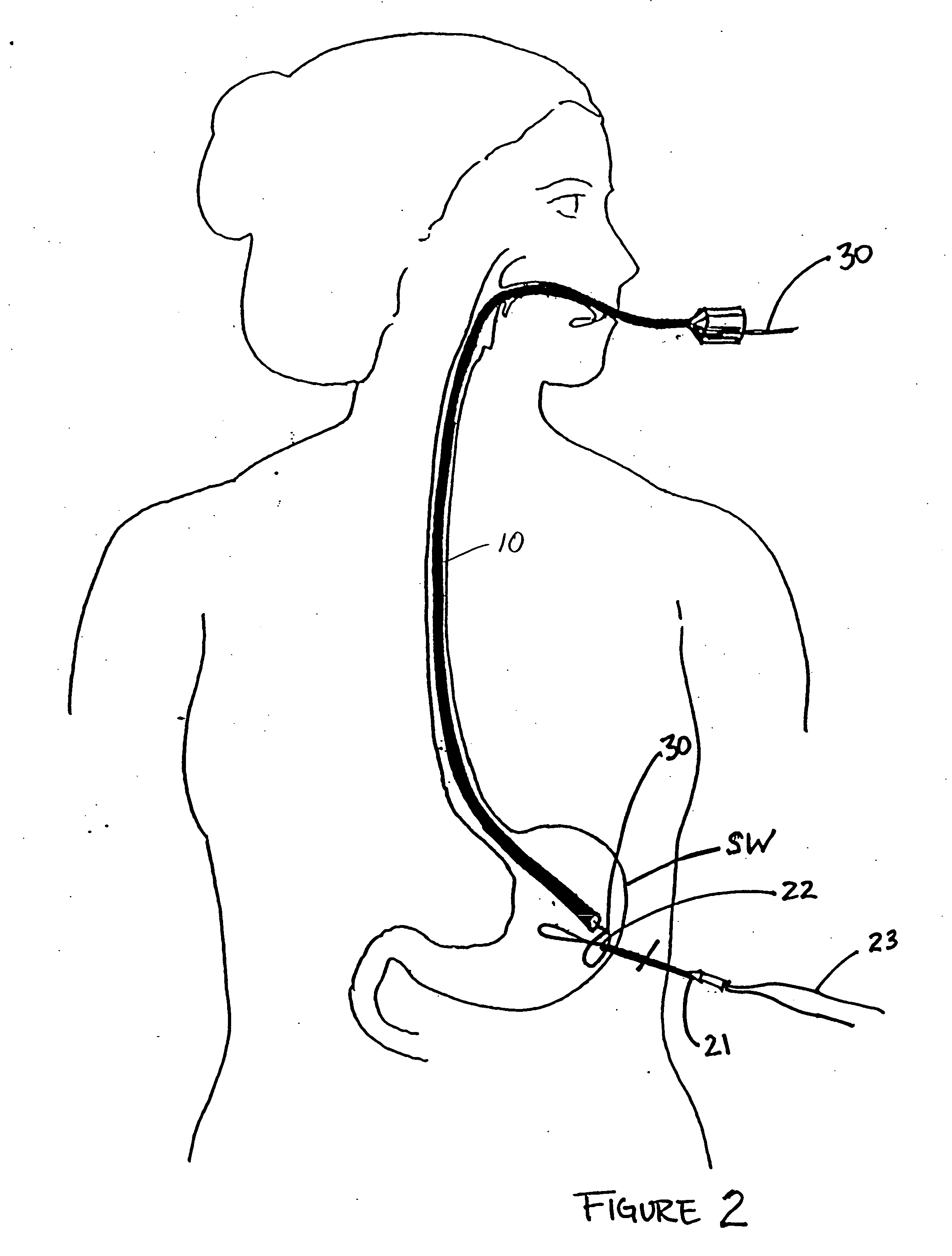 Method and device for use in minimally invasive placement of intragastric devices