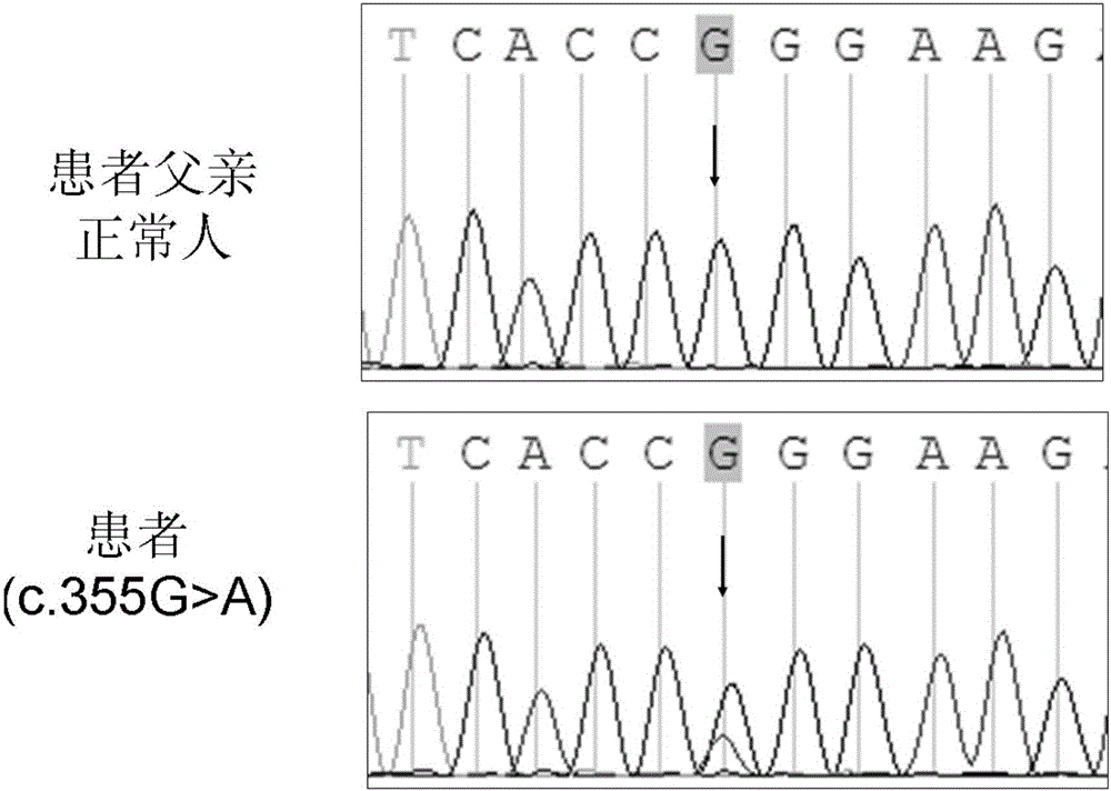 Application of CRYBB2 gene in preparation of product for detecting congenital cataract