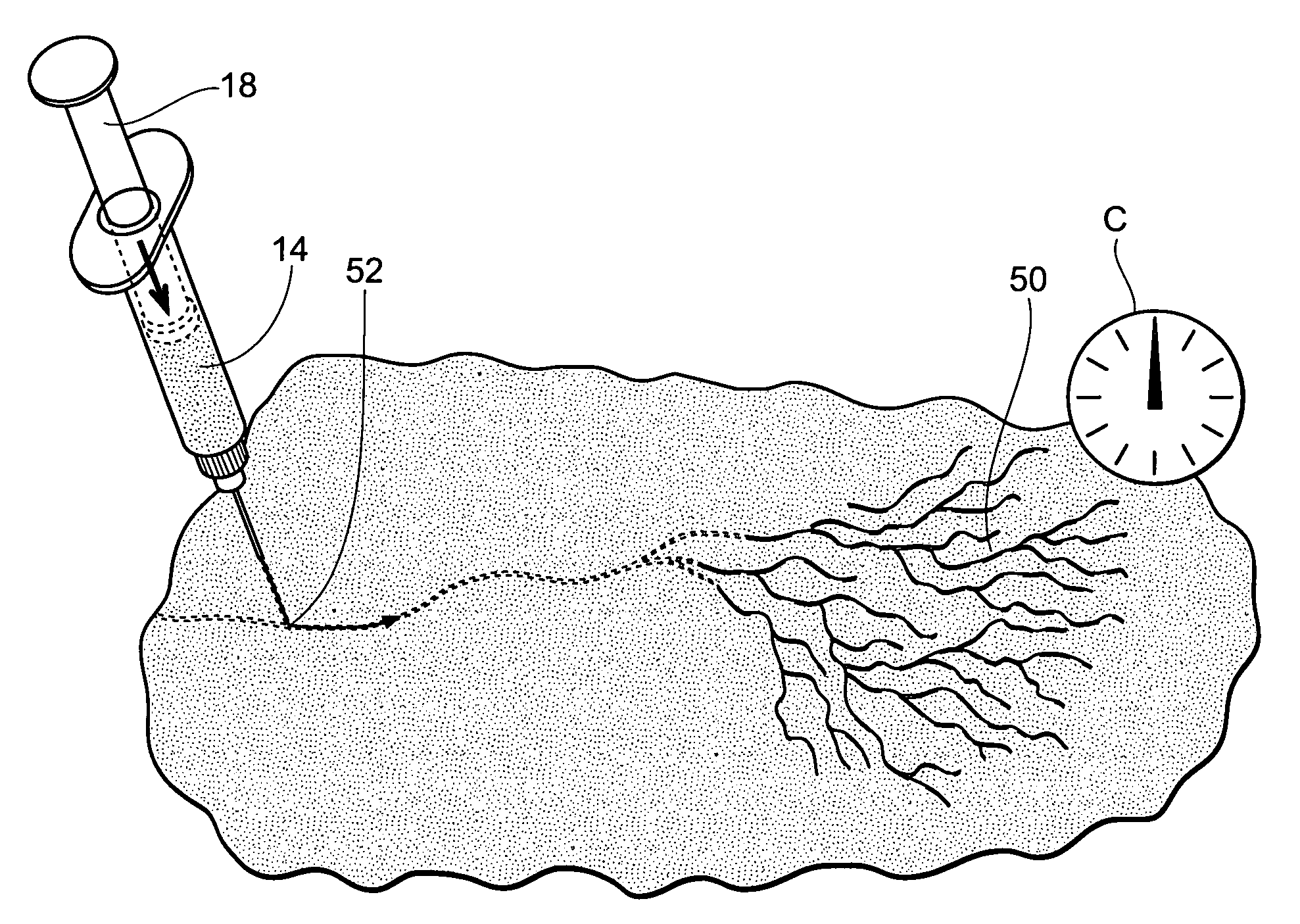 Systems and methods for treating superficial venous malformations like spider veins