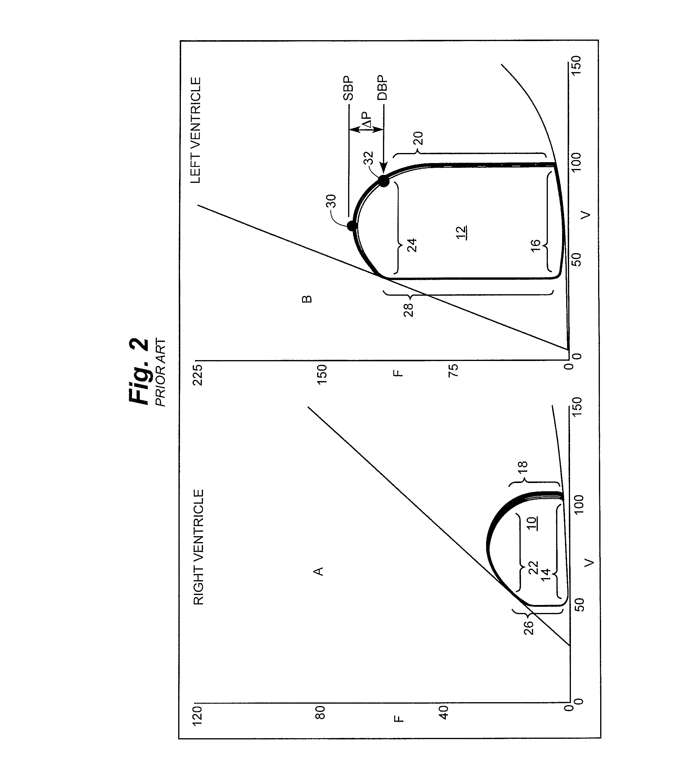 Cardiac Stimulation Apparatus And Method For The Control Of Hypertension