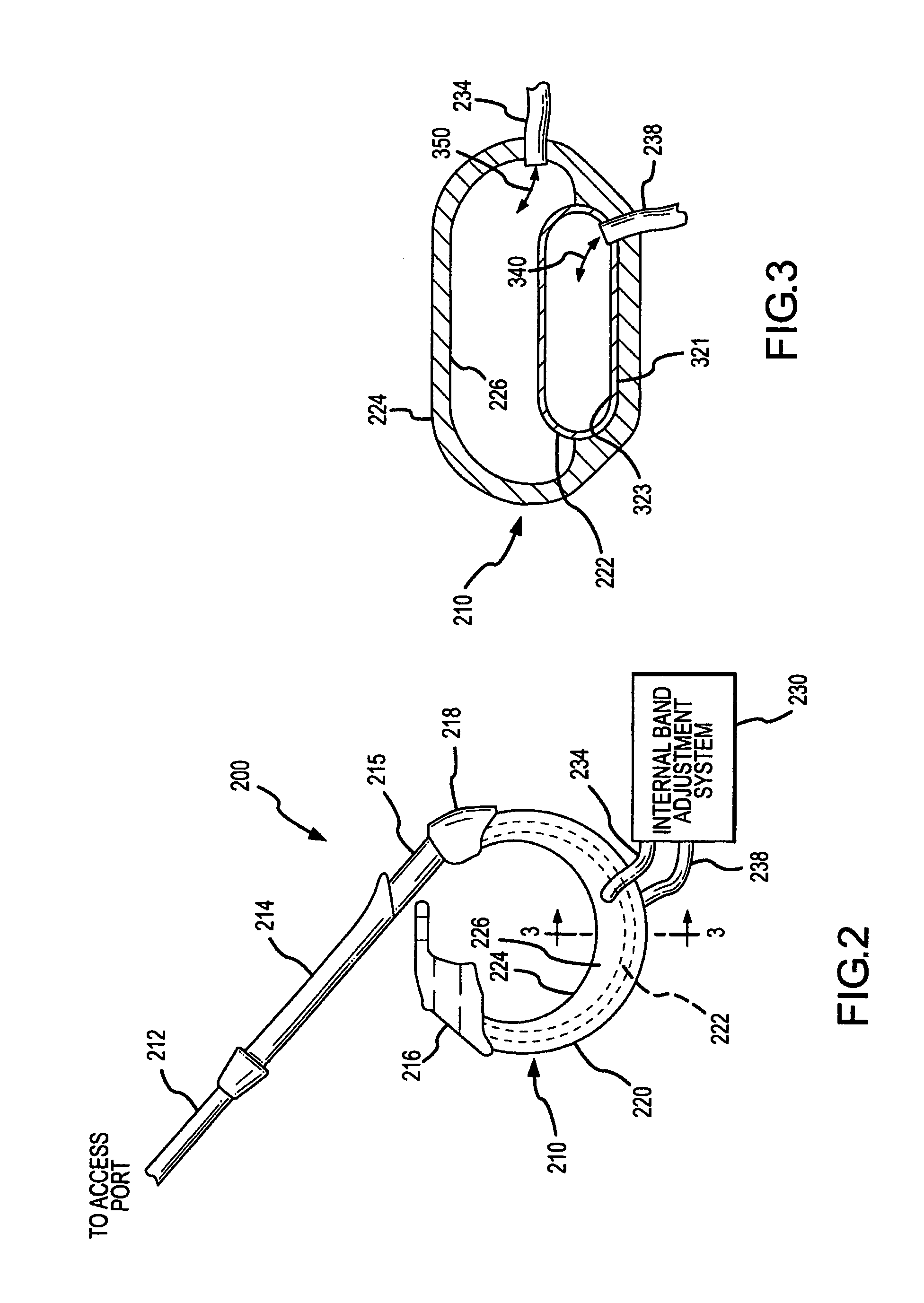 Self-regulating gastric band with pressure data processing